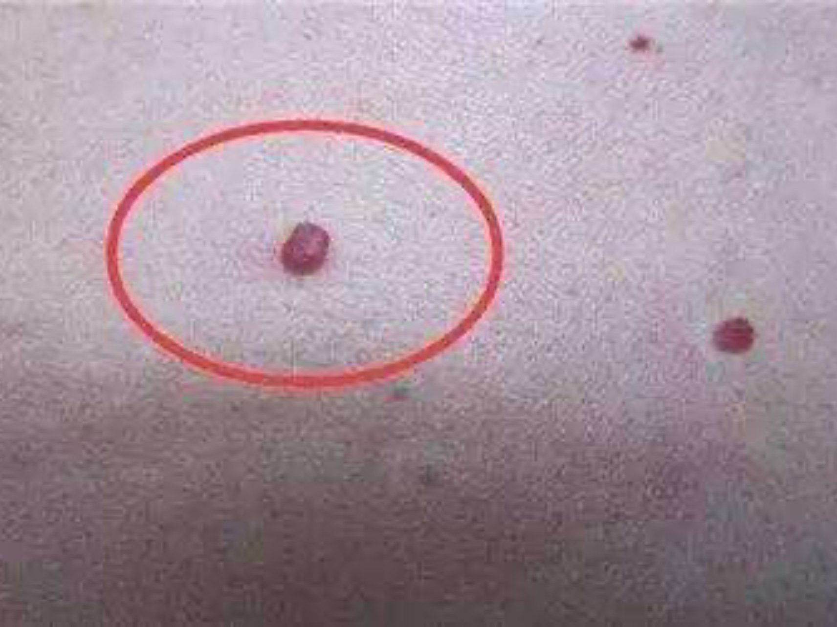 红血丝本质上就是毛细血管扩张,皮肤敏感,酒渣鼻,激素性皮炎,过冷