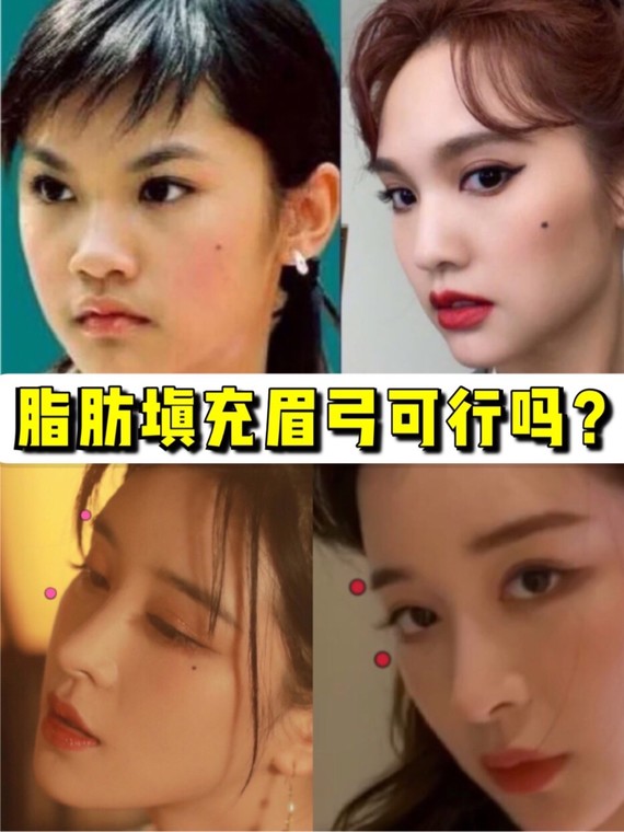 眉弓,又称为"眉骨",它是位于眼眶上缘的弓状隆起;_圈子-新氧美容整形