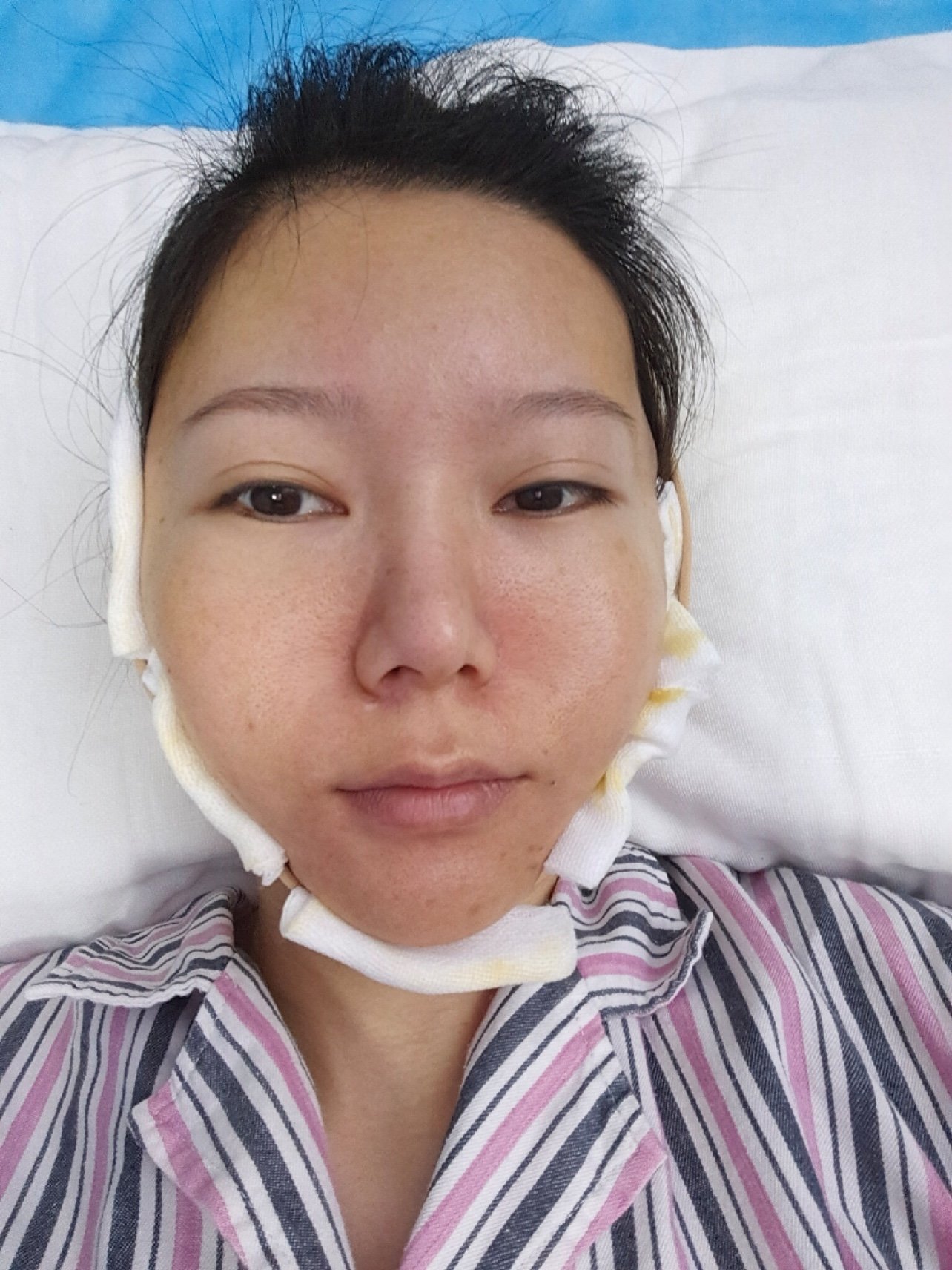 【下颌角切除第二天打卡】做女人太难了,要贤惠要漂亮_圈子-新氧美容