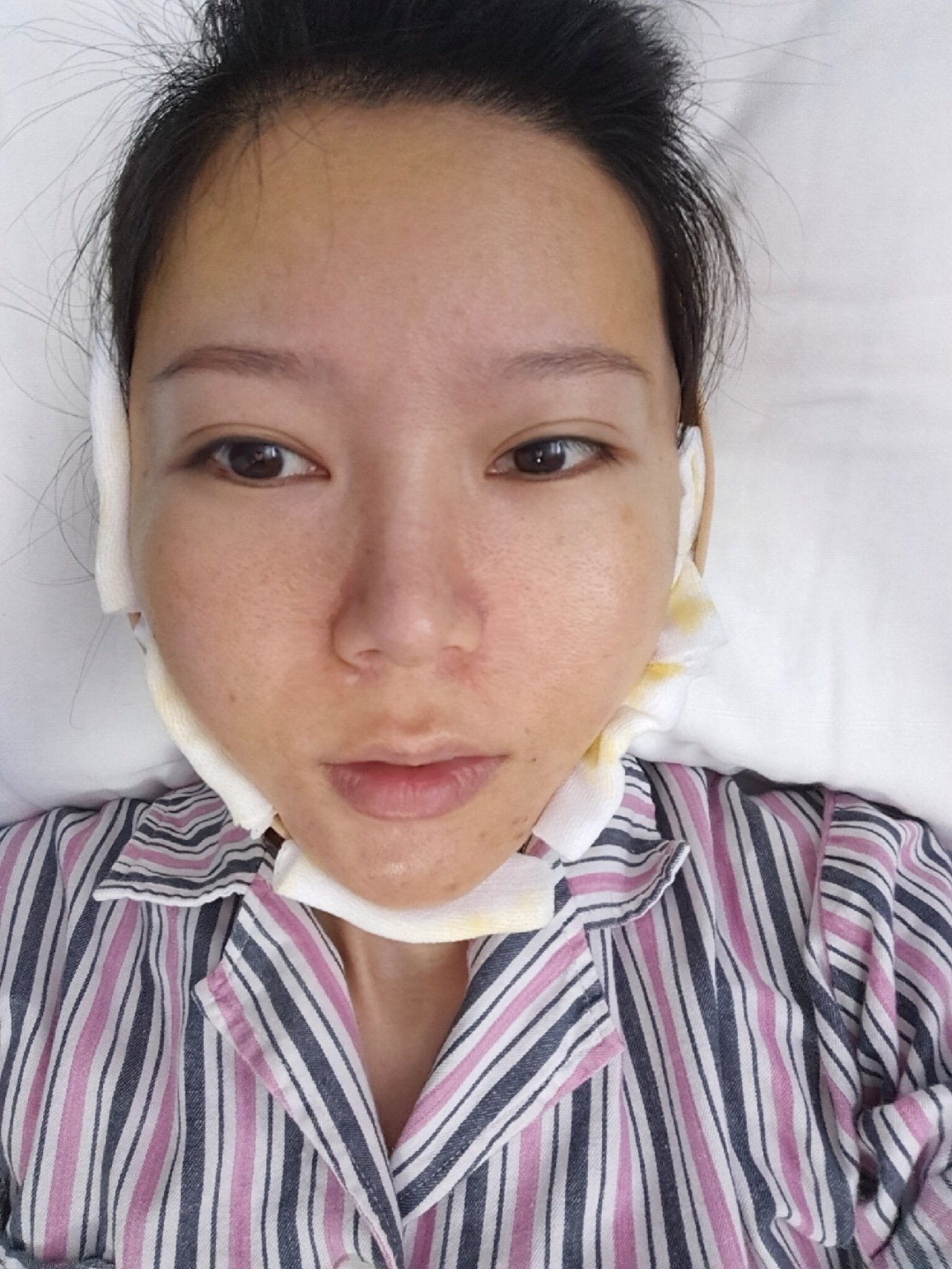 【下颌角切除第二天打卡】做女人太难了,要贤惠要漂亮_圈子-新氧美容