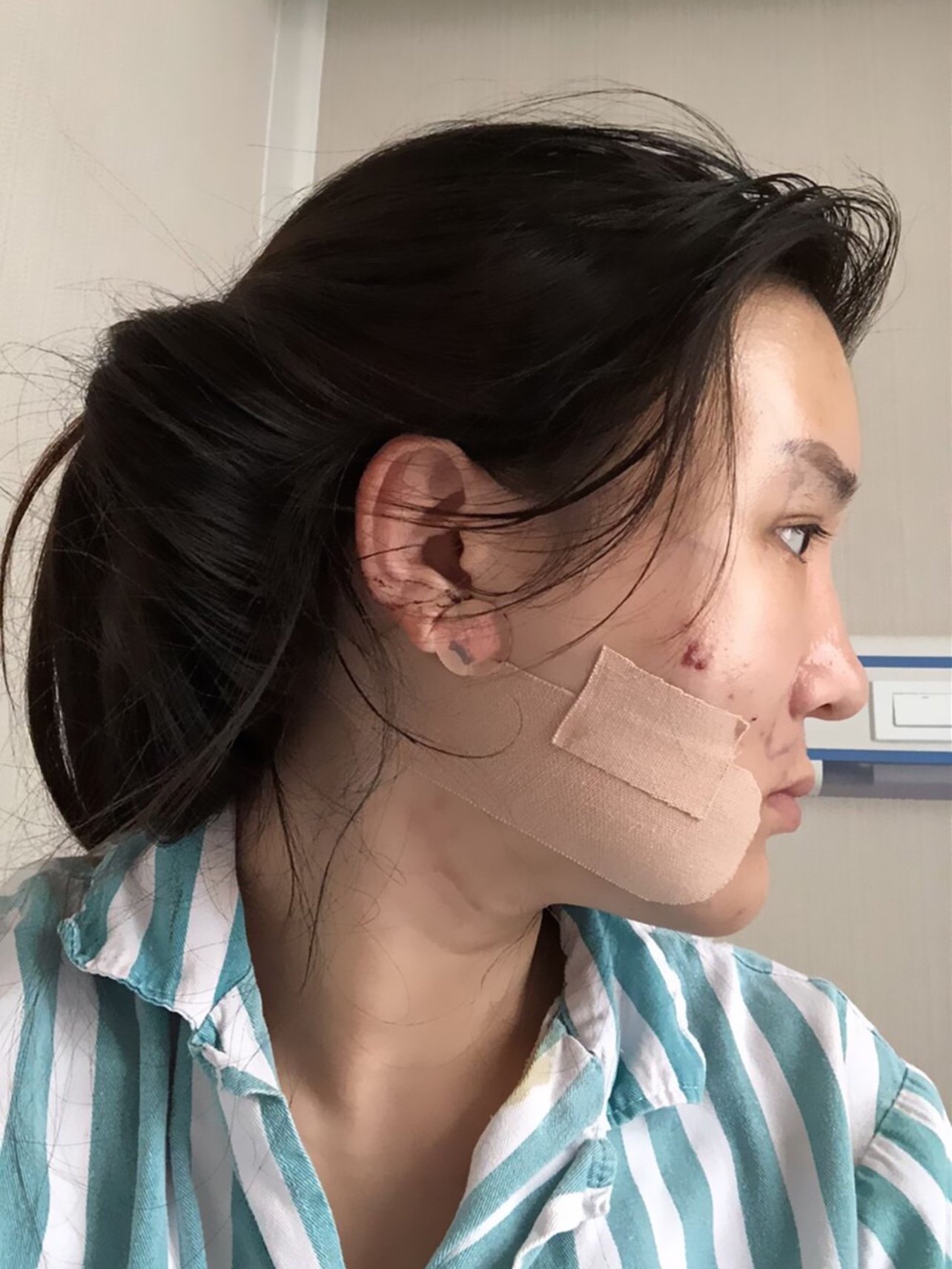 【青岛华颜美-面部上填下吸术后第2天】