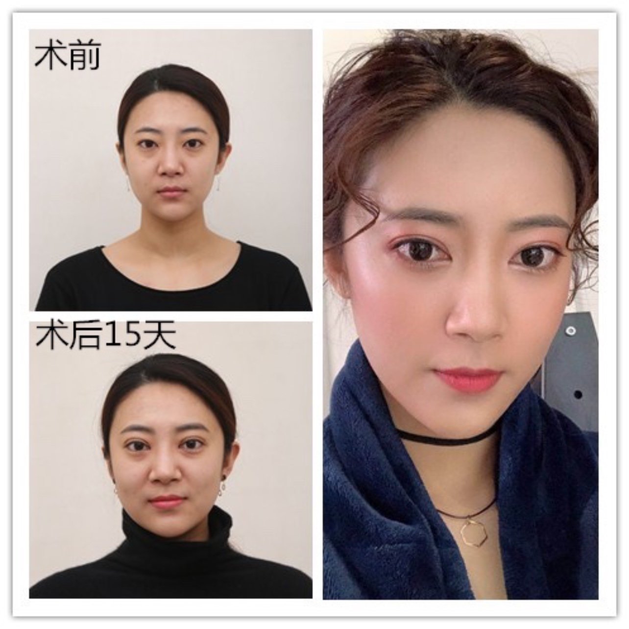 眼角内包,重睑线不明显