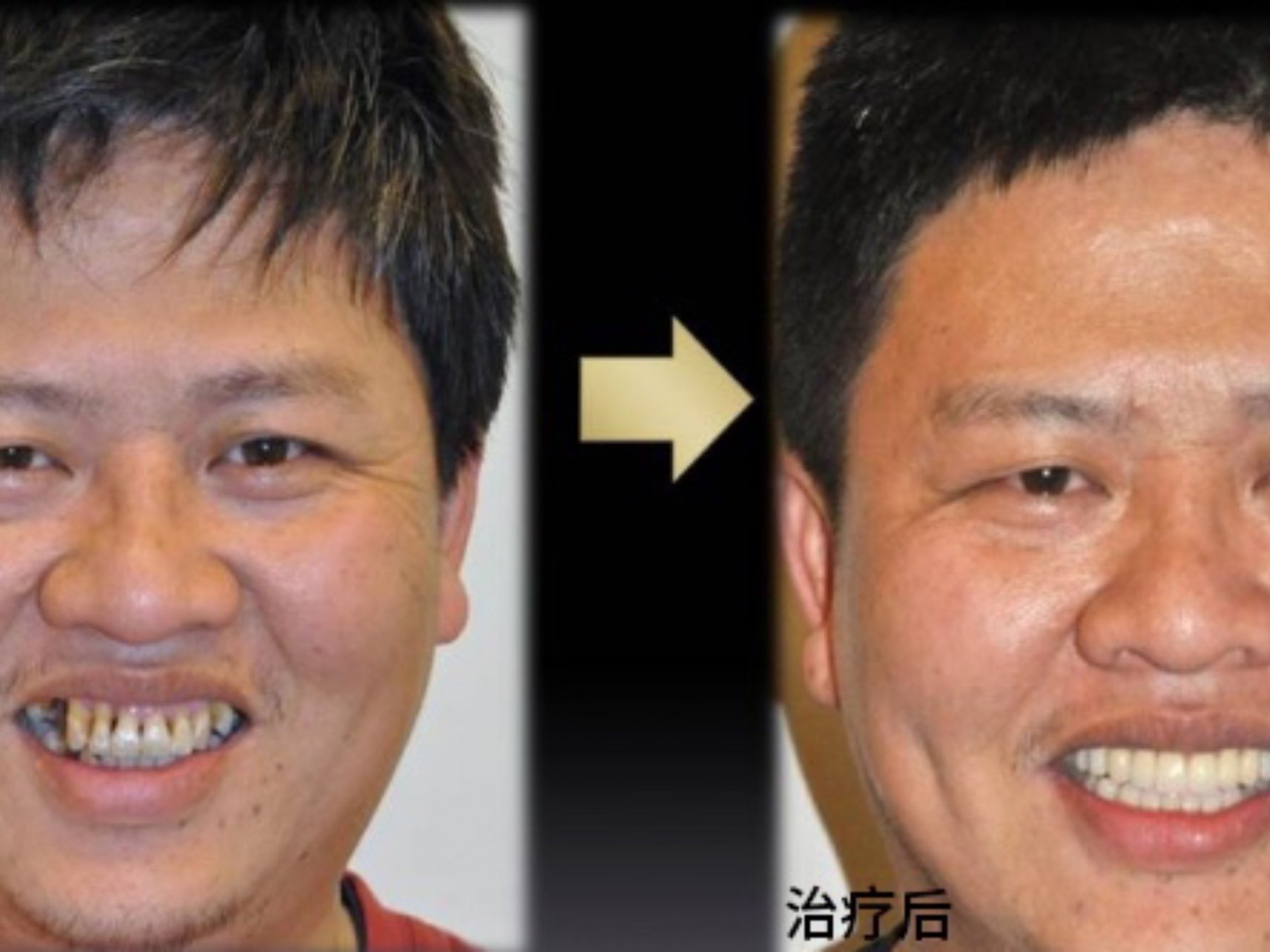 吃槟榔这些,牙齿越来越黄_圈子-新氧美容整形