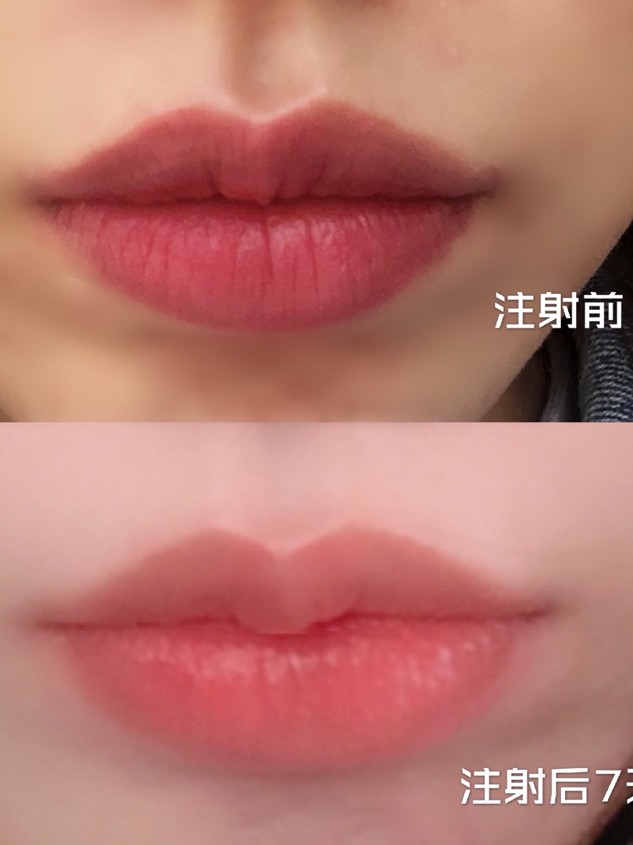 打嘟嘟唇适合什么样的玻尿酸