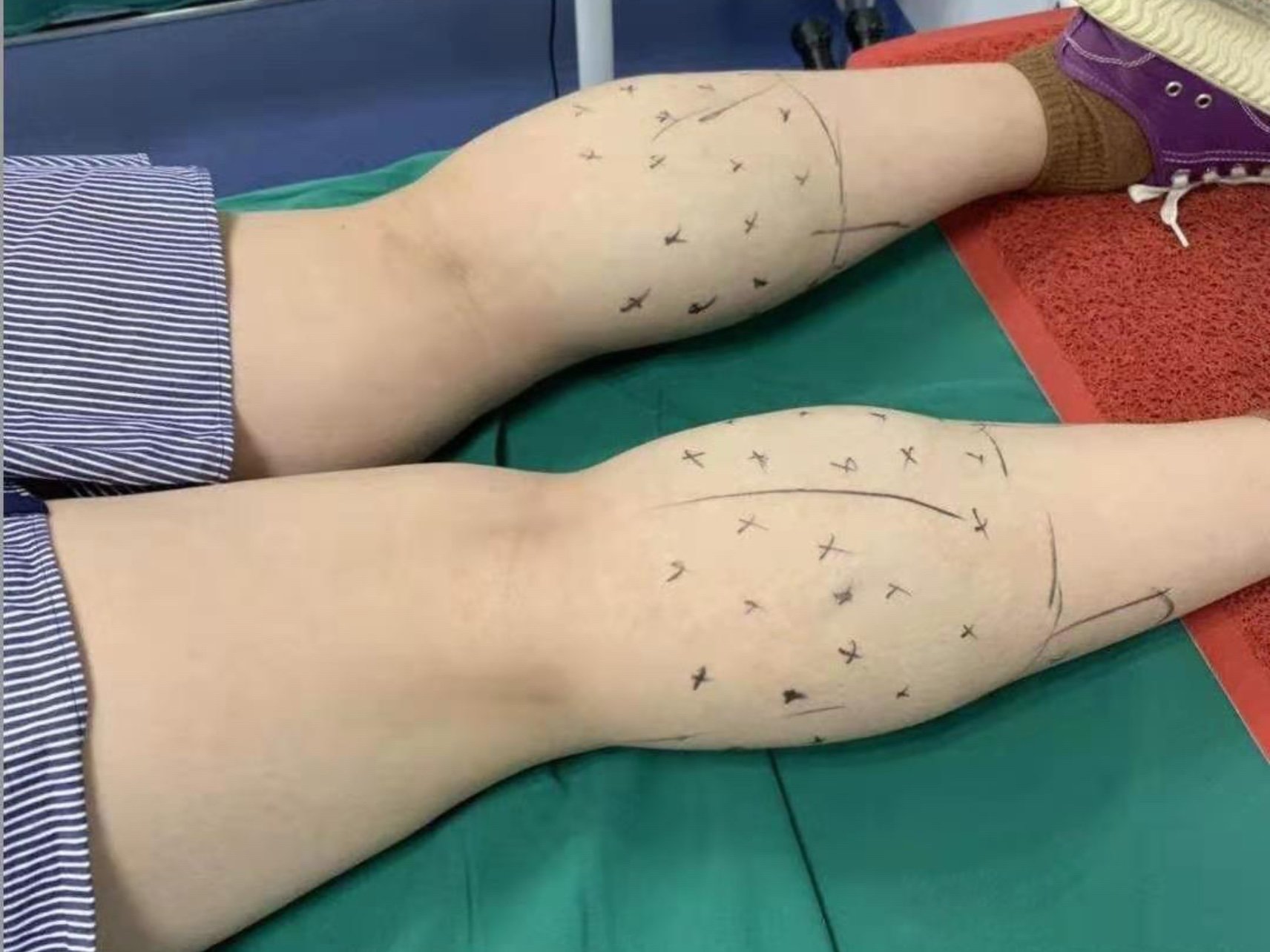 打完瘦腿针二十天的时候就明显感到小腿肌肉变软了