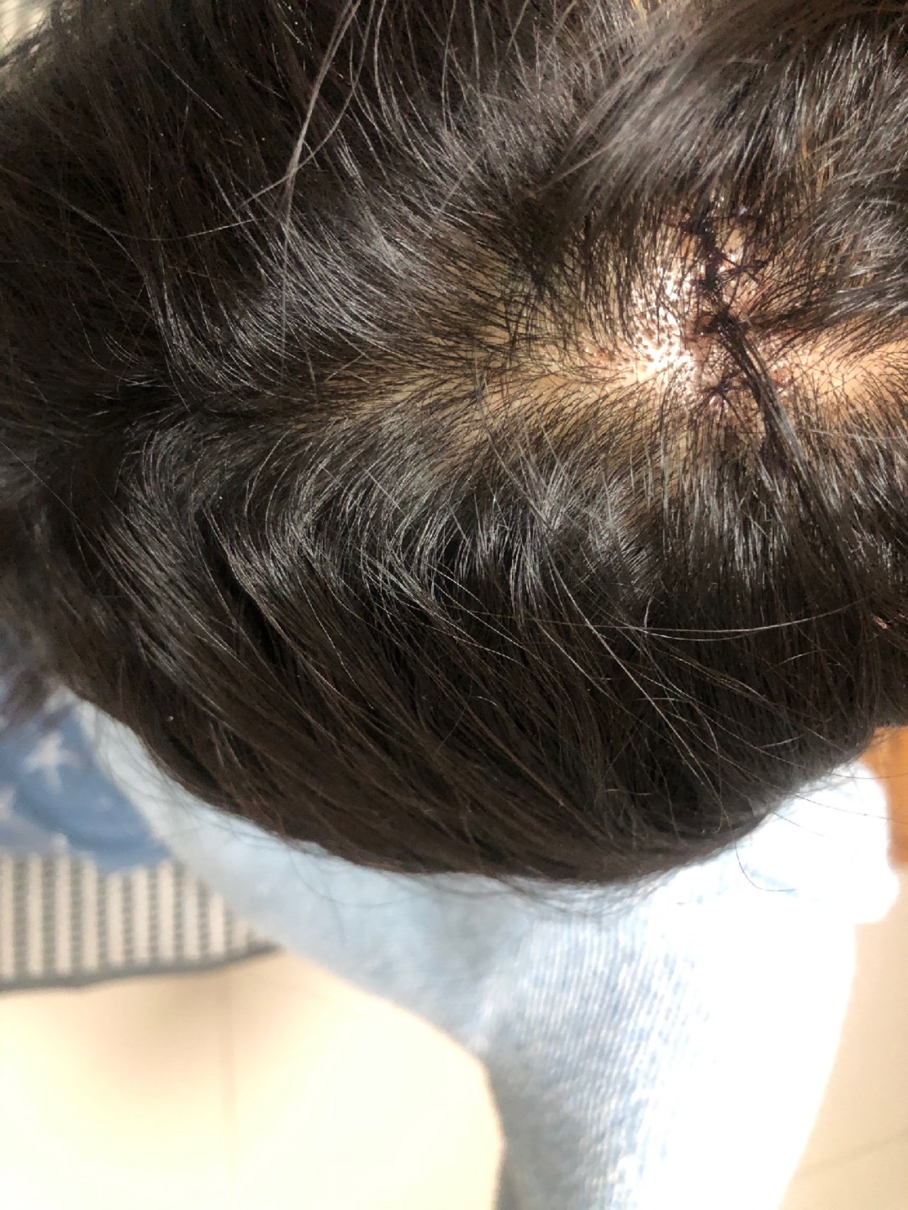终于忍到可以拆线了98,这七天不洗头发还是挺难熬的,_圈子-新氧美容