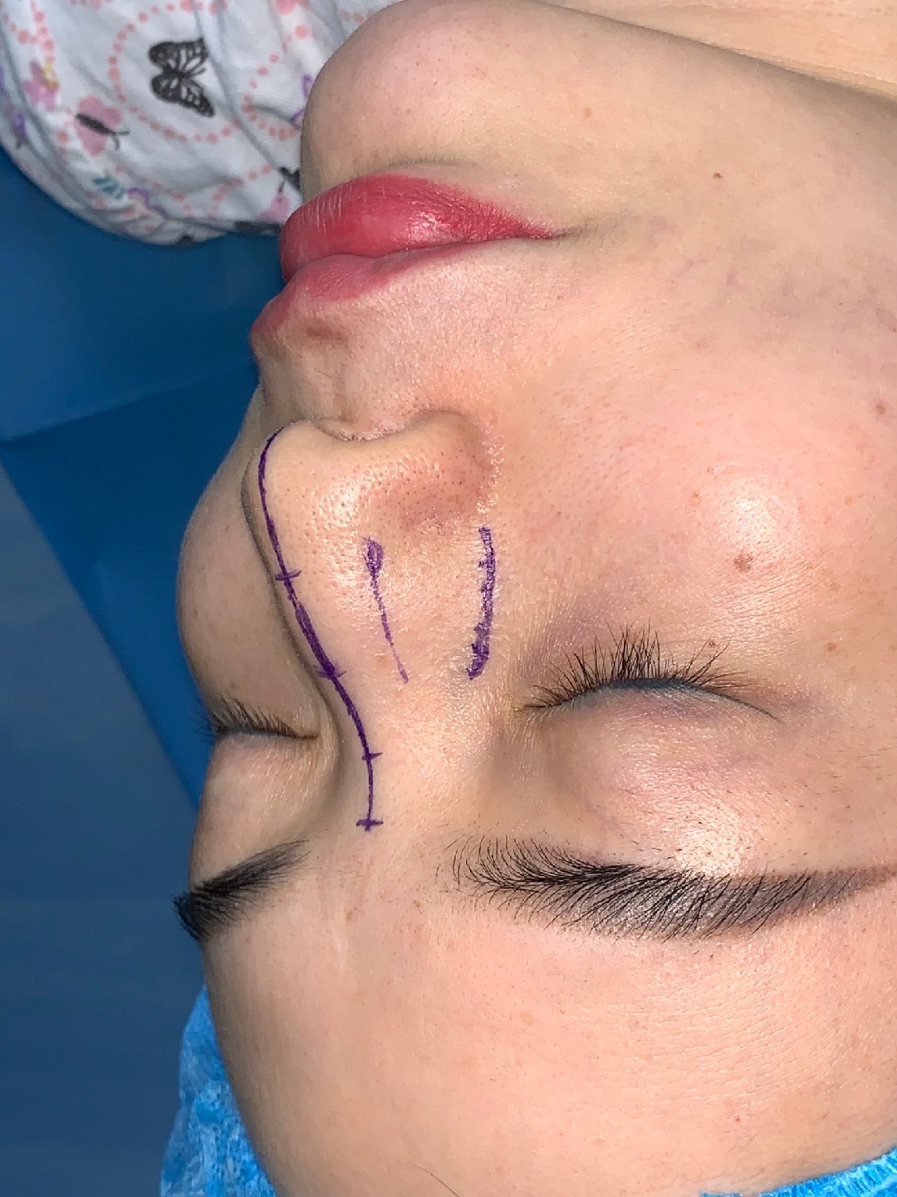 驼峰宽鼻鼻骨截骨缩窄