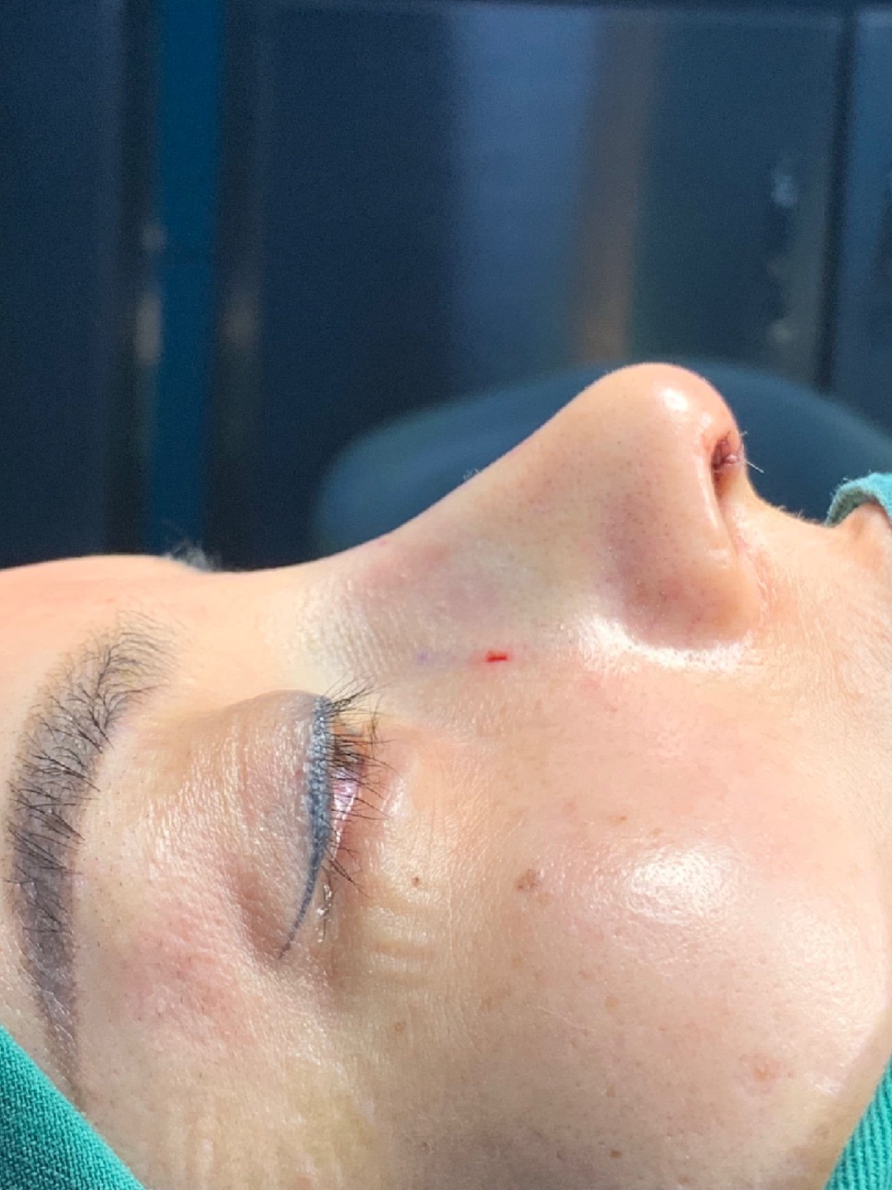 驼峰宽鼻鼻骨截骨缩窄