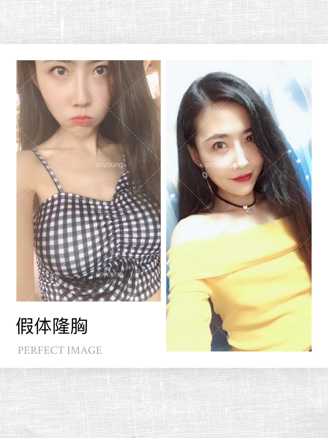 从a到c 假体丰胸90天变化