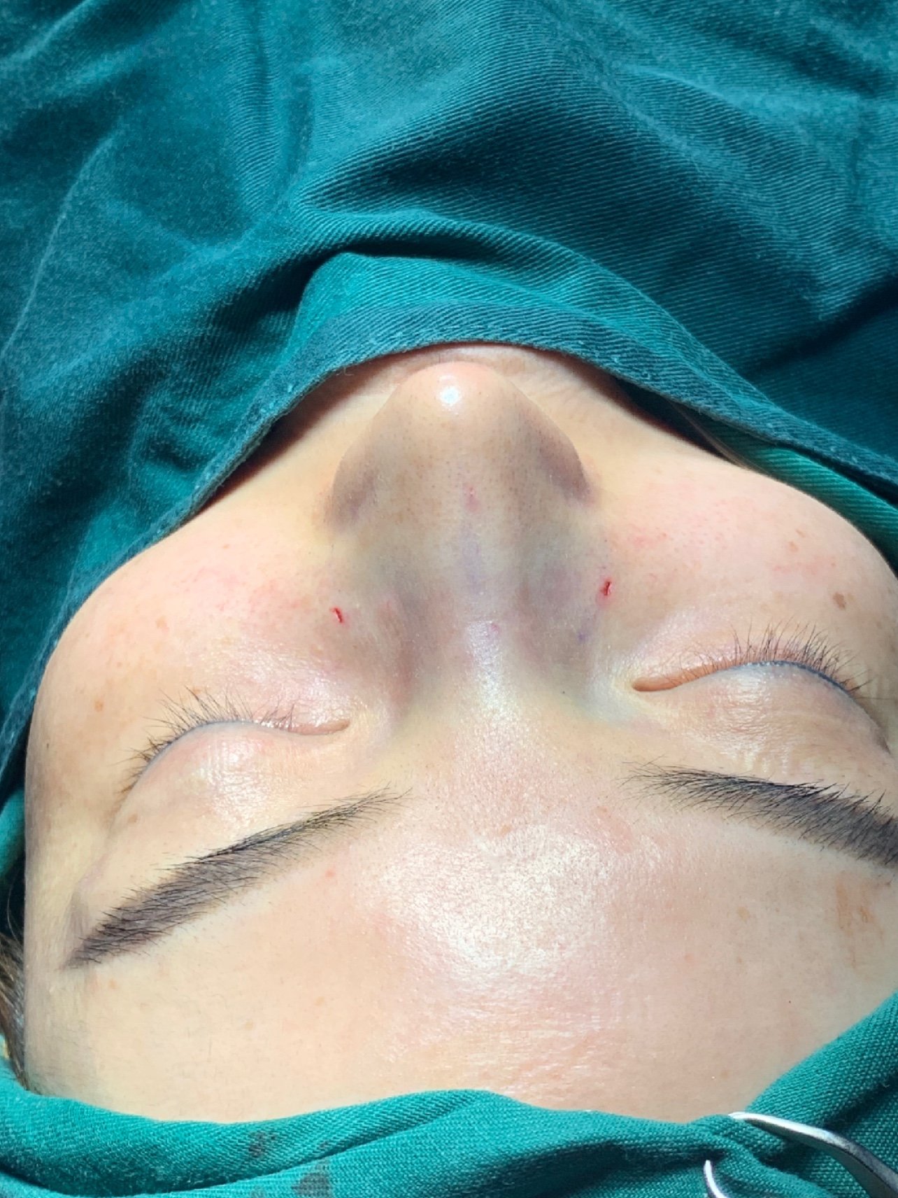 驼峰宽鼻鼻骨截骨缩窄