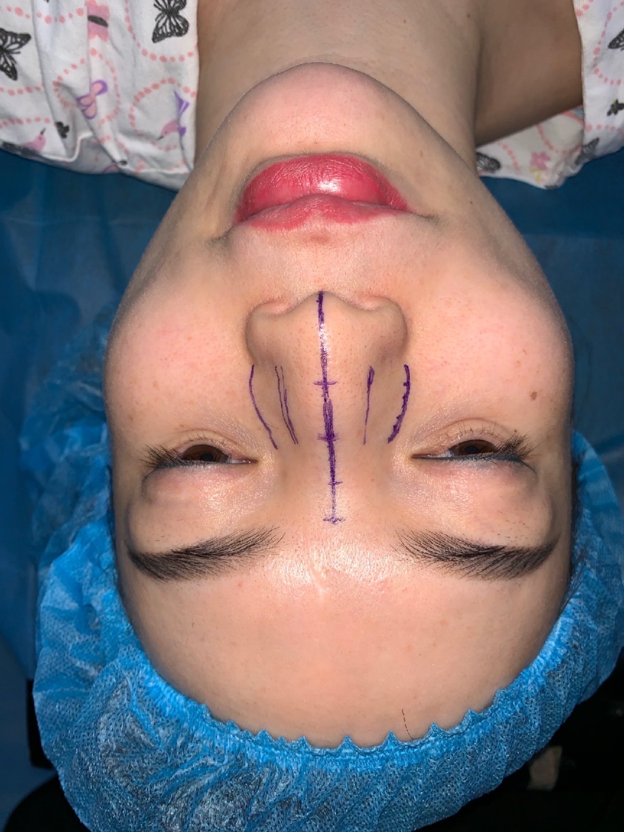 驼峰宽鼻鼻骨截骨缩窄