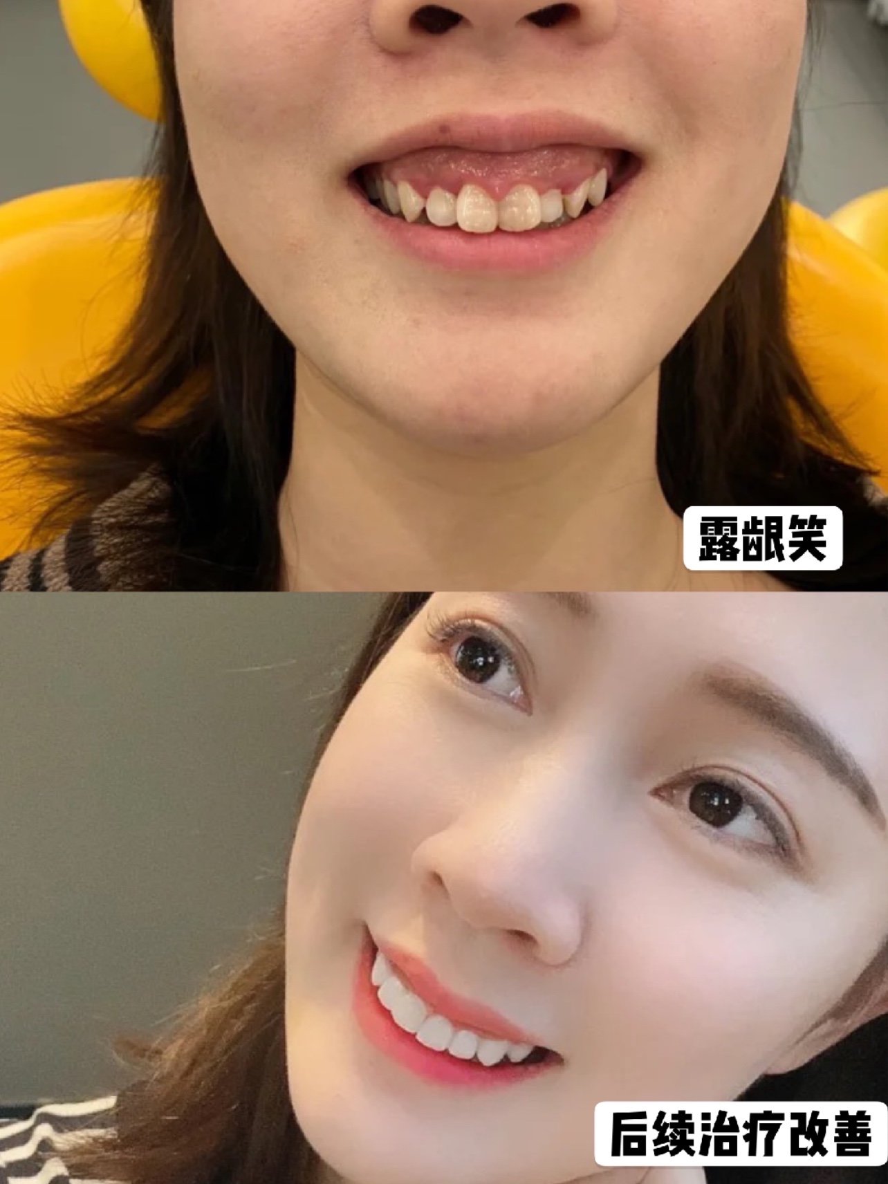 拯救露龈笑小姐姐,摘下牙套超美丽