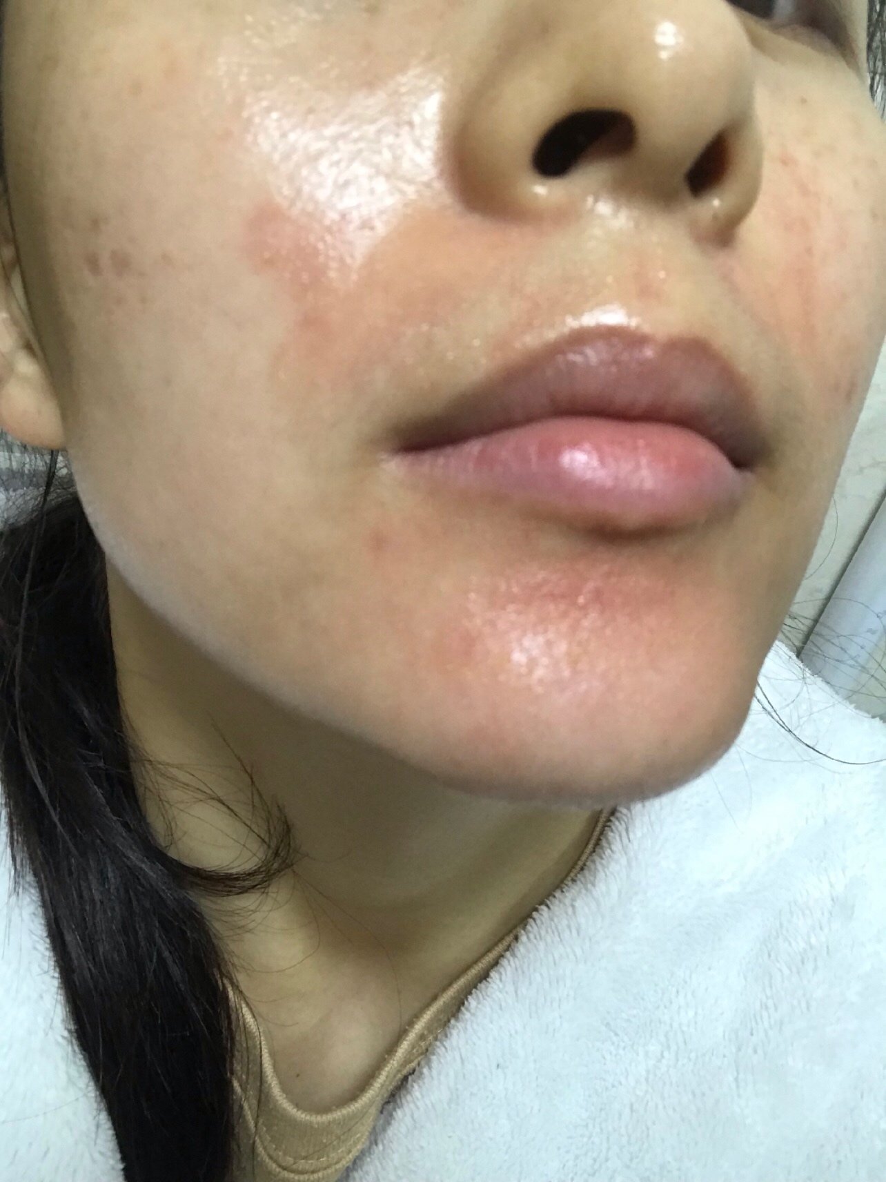 当天打完水光_圈子-新氧美容整形