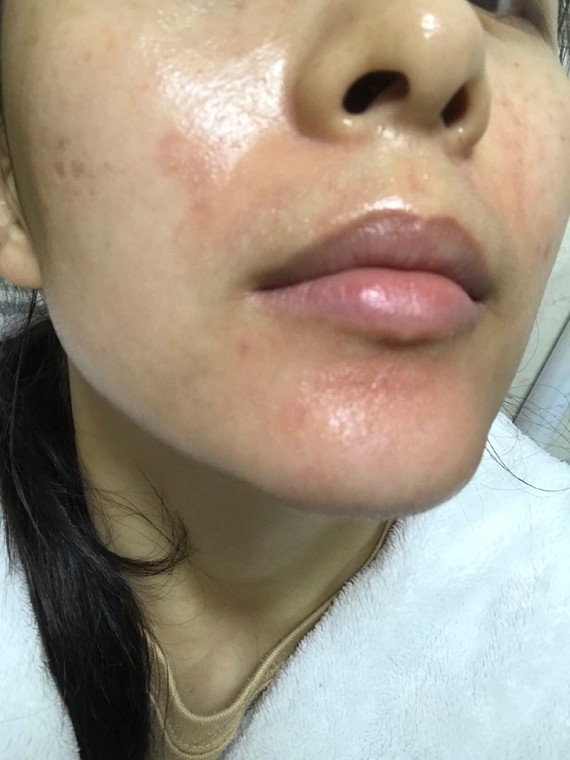 水光补水后第三天频繁敷面膜的我过敏了