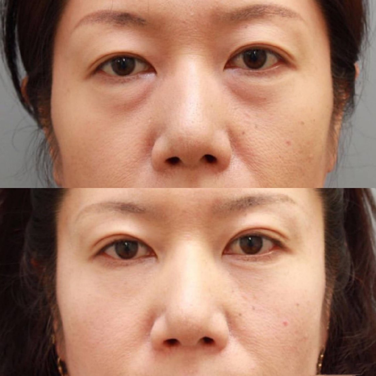 一直想做fotona4d欧洲之星祛眼袋,犹豫了很久_圈子-新氧美容整形