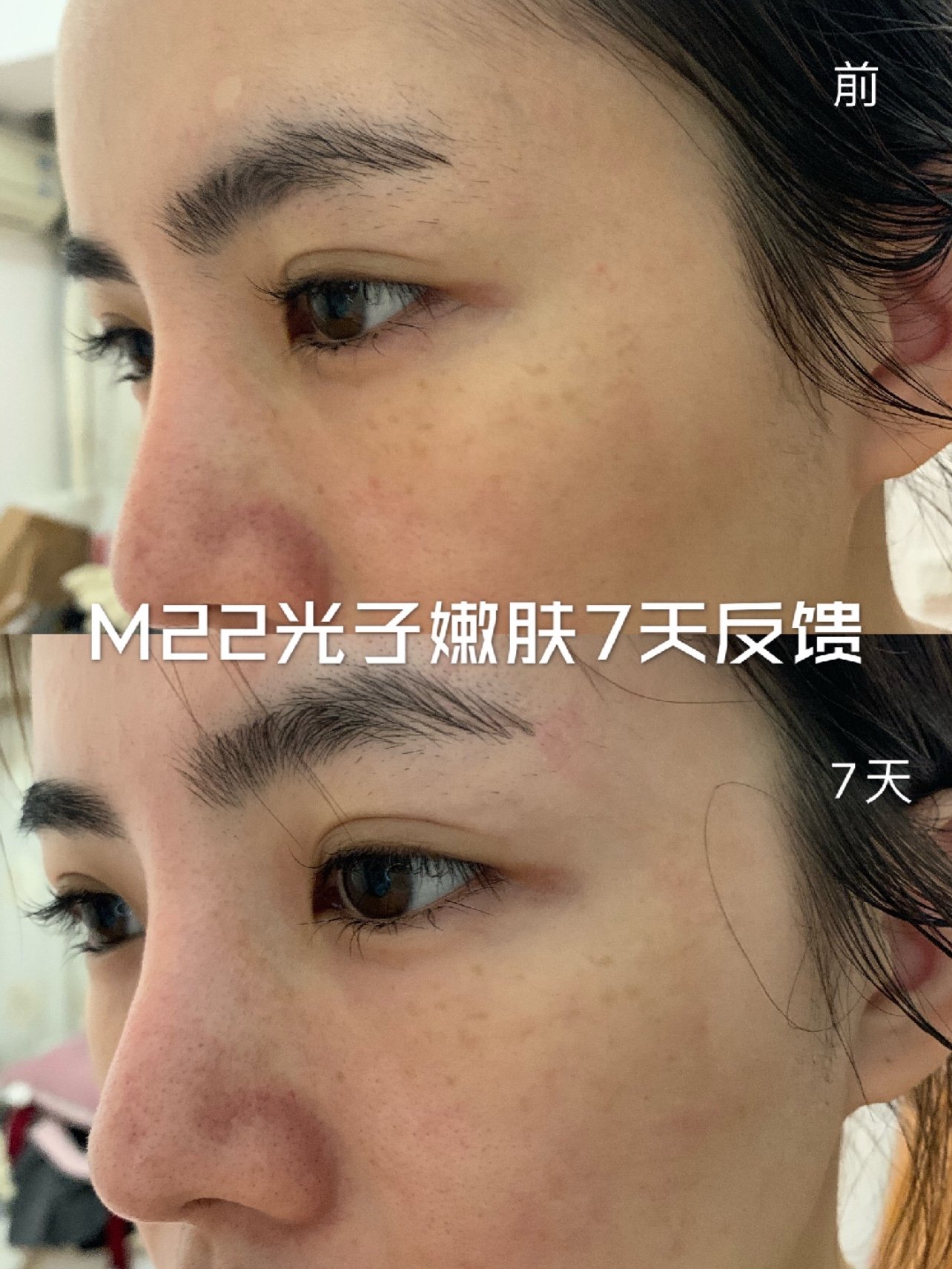 m22光子嫩肤7天反馈