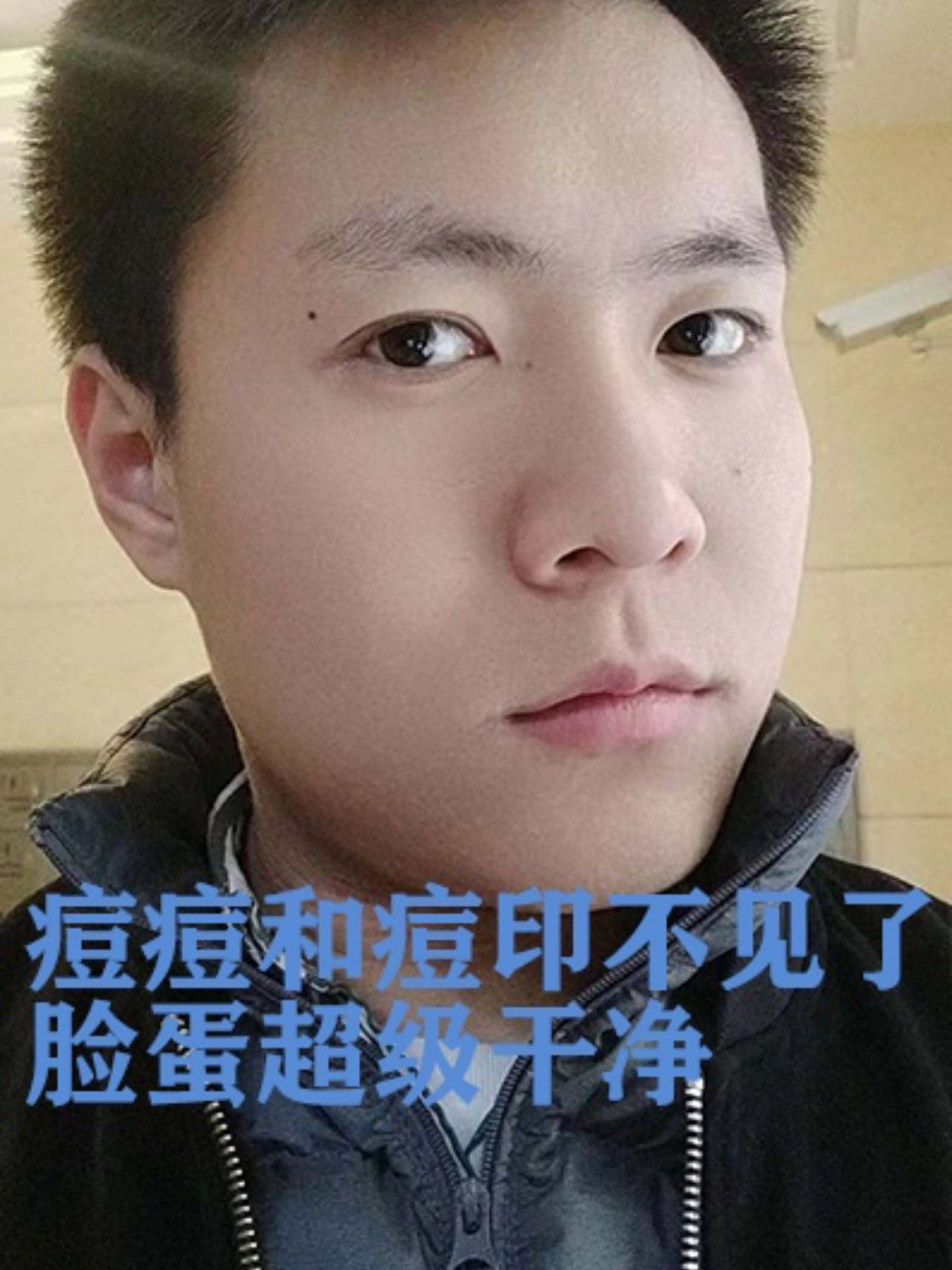 小帅哥是混合偏油性肌肤,经常长痘,大油田,脸上还有很多痘痘和痘印.