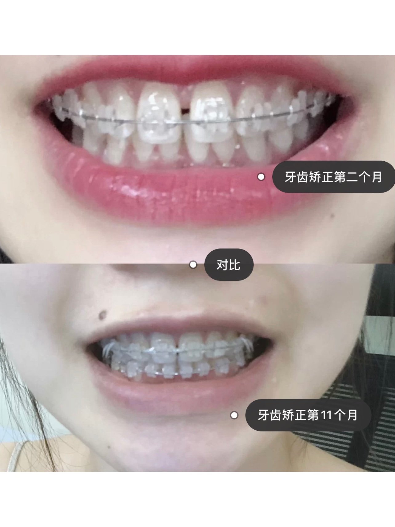 半隐形牙齿矫正#牙缝大#深覆盖