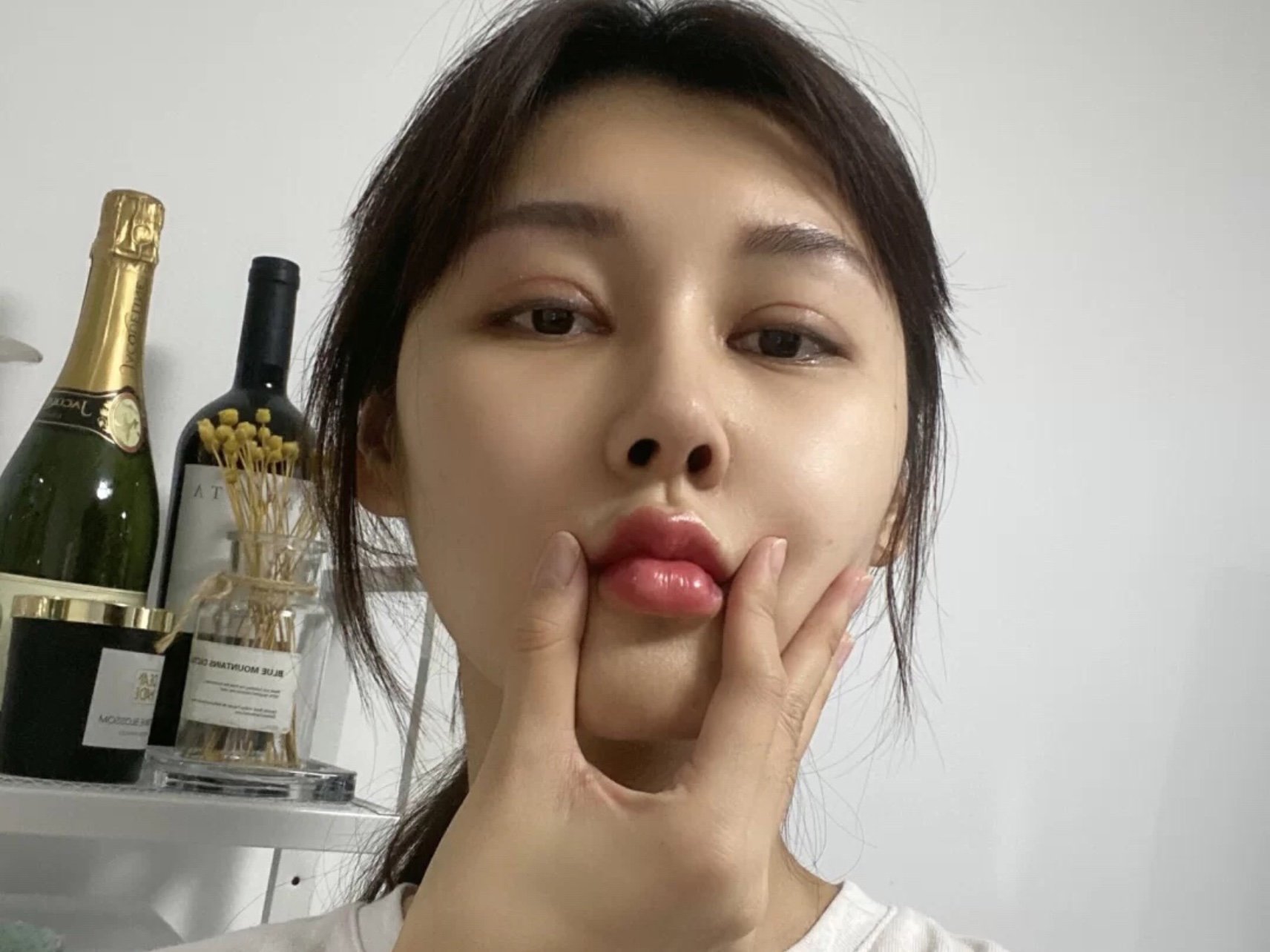 自从自己玻尿酸注射了嘴唇之后,我看谁都盯着别人的嘴唇看,我发现