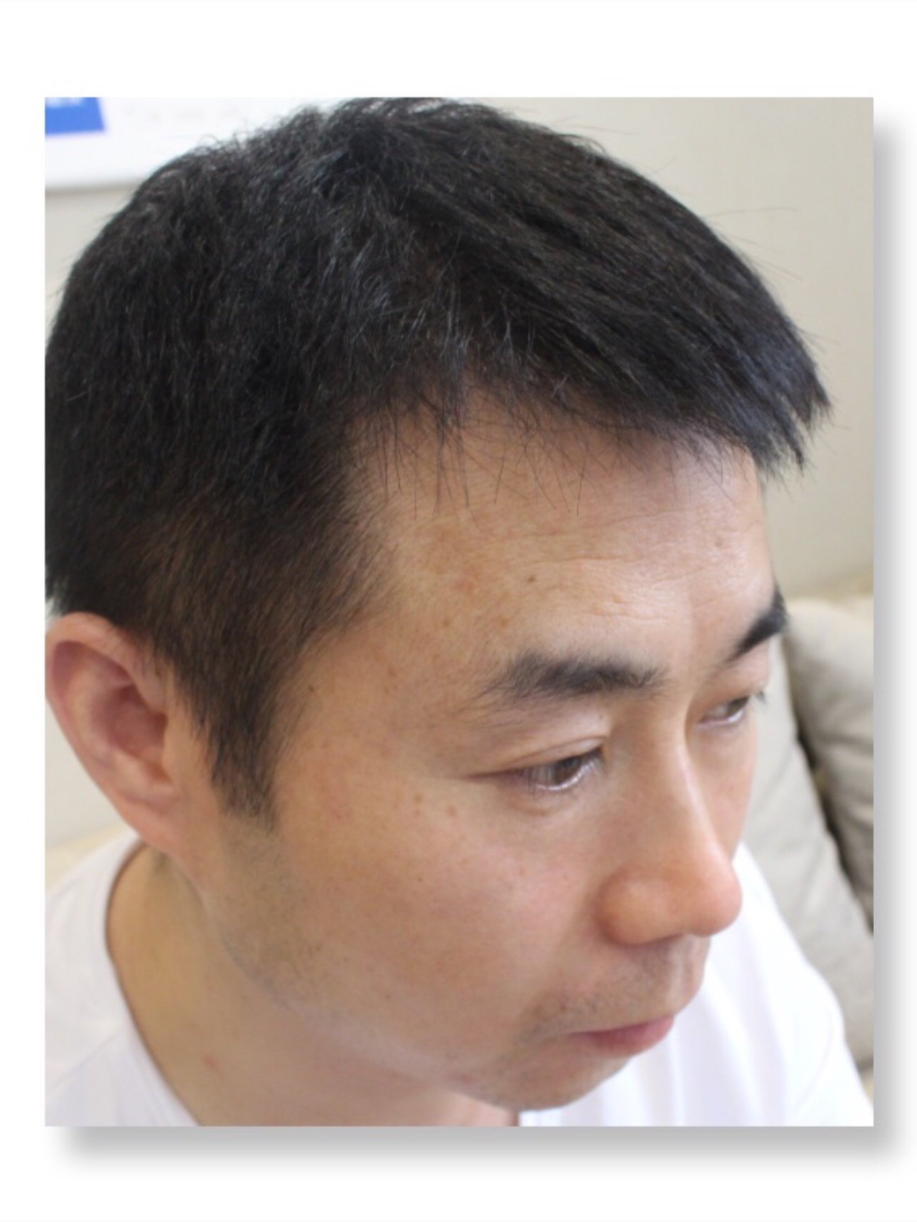 没想到脱发这么快就来了,头顶稀疏发量逐年减少,再发_圈子-新氧美容