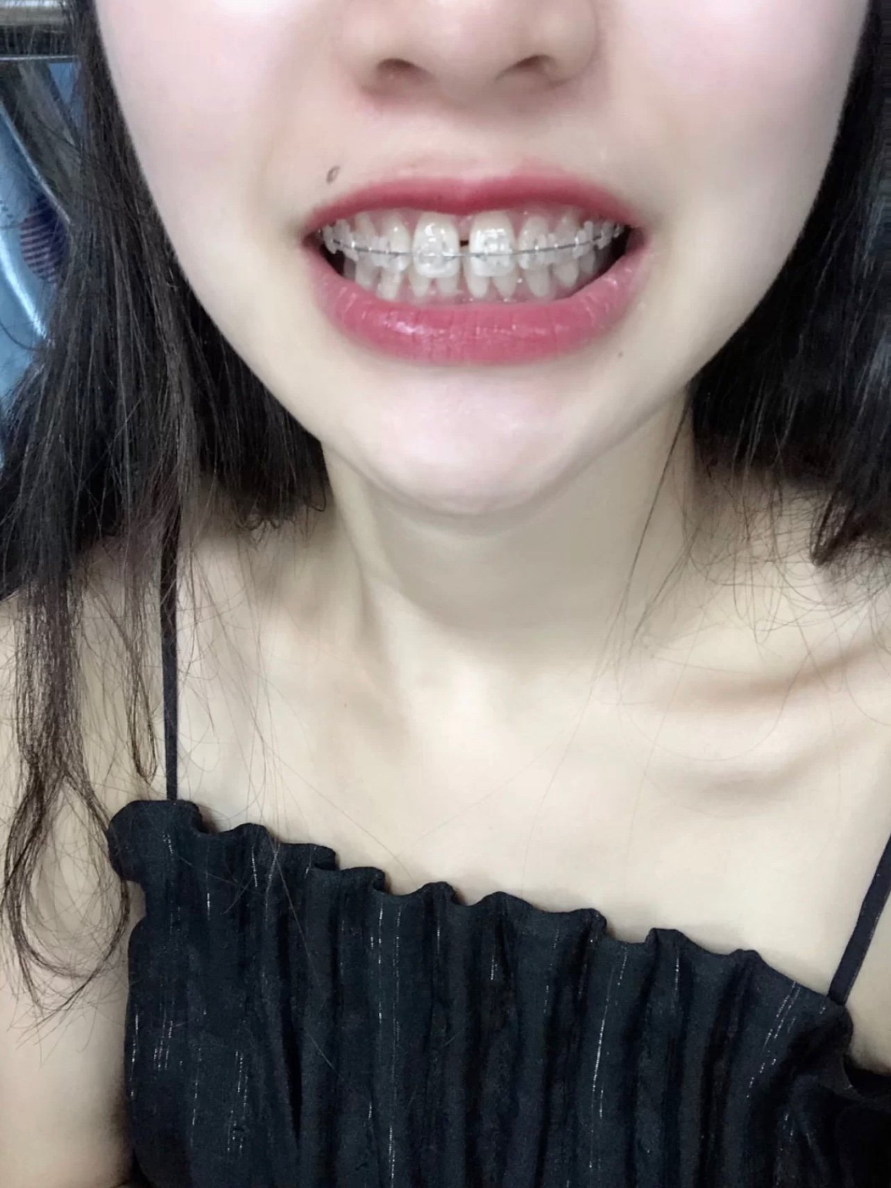 半隐形牙齿矫正#牙缝大#深覆盖