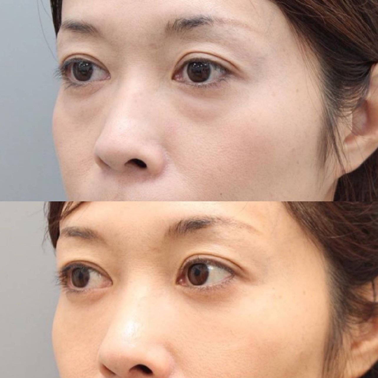 上海维莎医疗美容的内吸祛眼袋效果真的不错,平时热衷_圈子-新氧美容