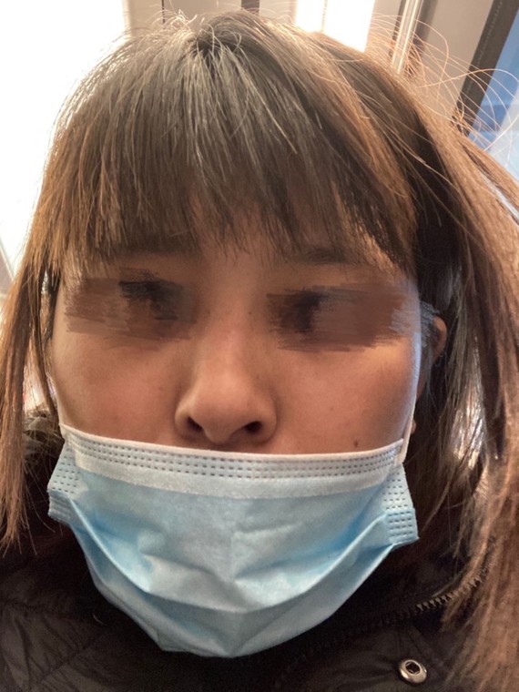 在上上相做完隆鼻手术后鼻背发红鼻小柱歪斜鼻梁歪斜鼻_圈子-新氧美容