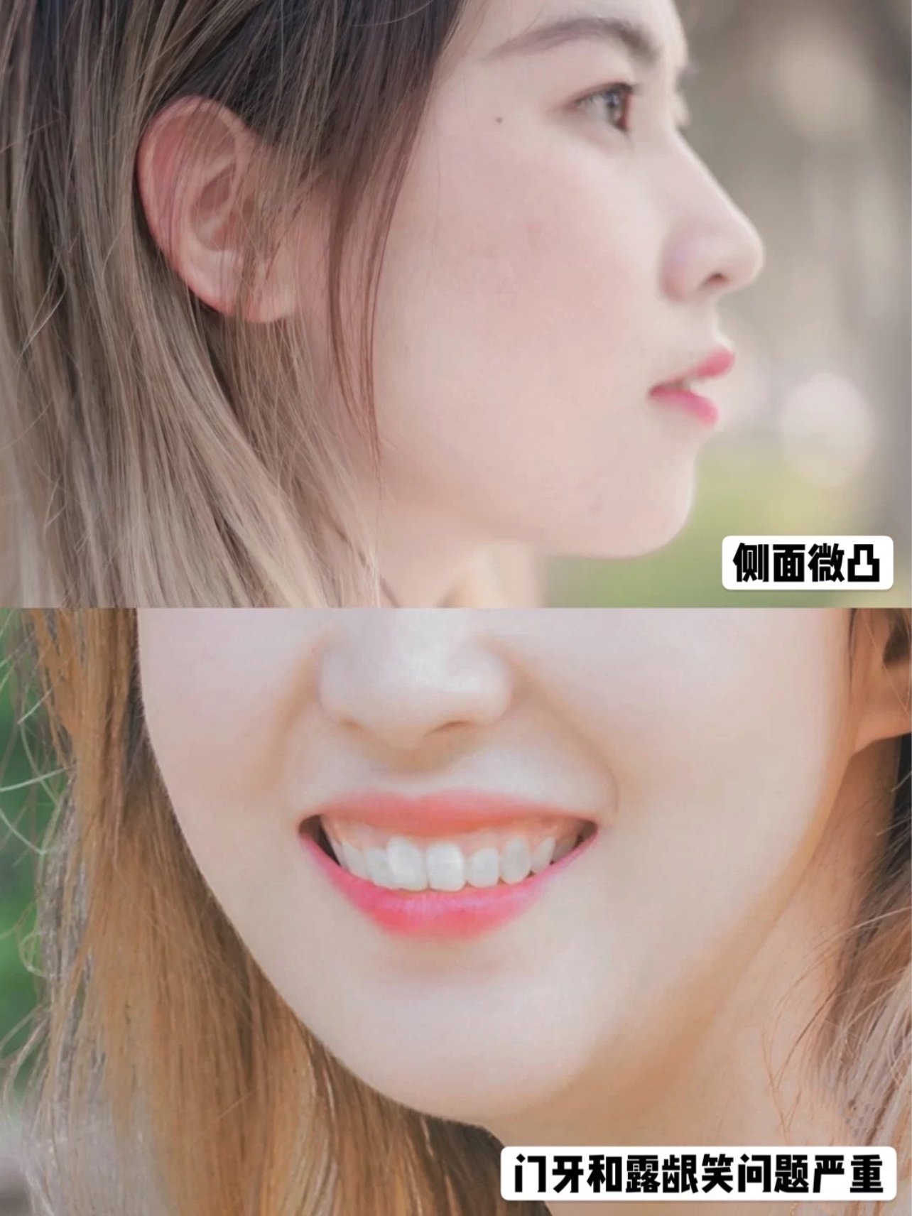 摆脱兔牙后,在本命年实现颜值逆袭~9799牙齿问题:兔_圈子-新氧