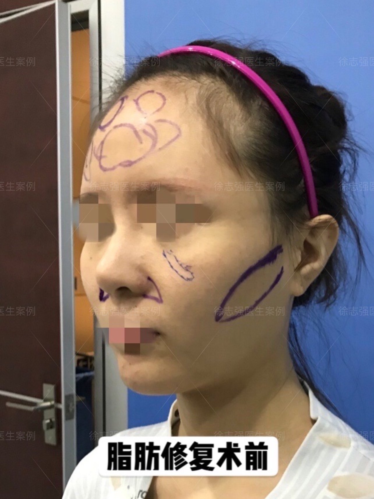 脂肪修复案例填充后面部凹凸不平怎么办