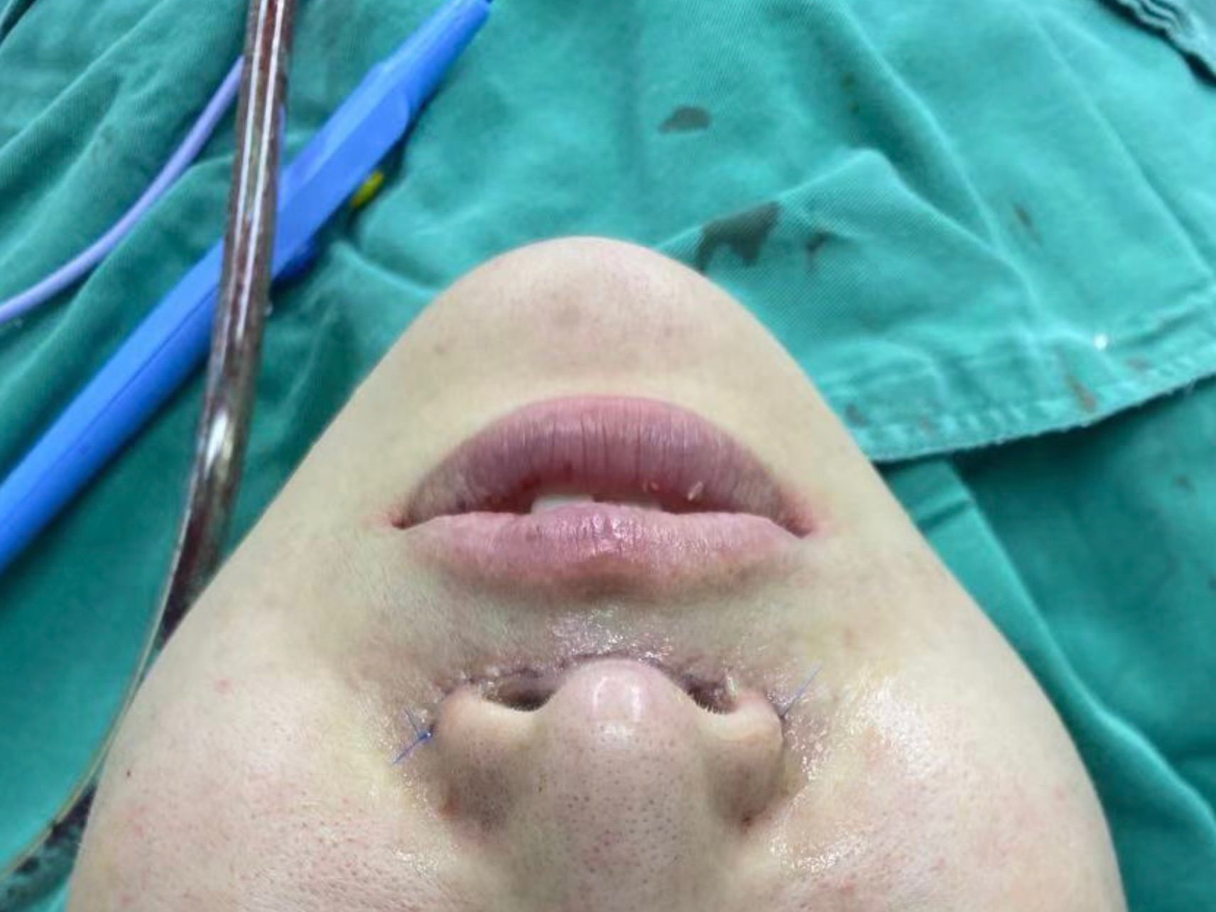 人中长了特别的难看,还会显得老气,听说人中缩短手术_圈子-新氧美容