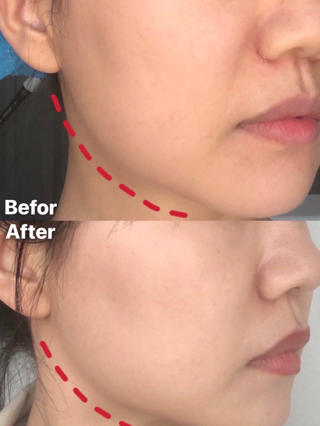 fotona4d术后一周多溶脂紧致效果绝了