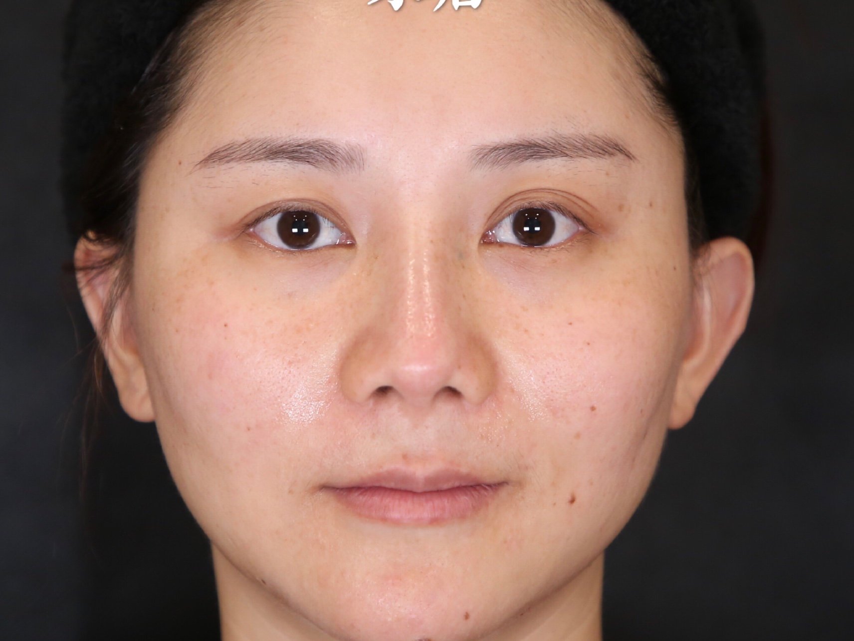 术前法令纹泪沟严重沧桑显老