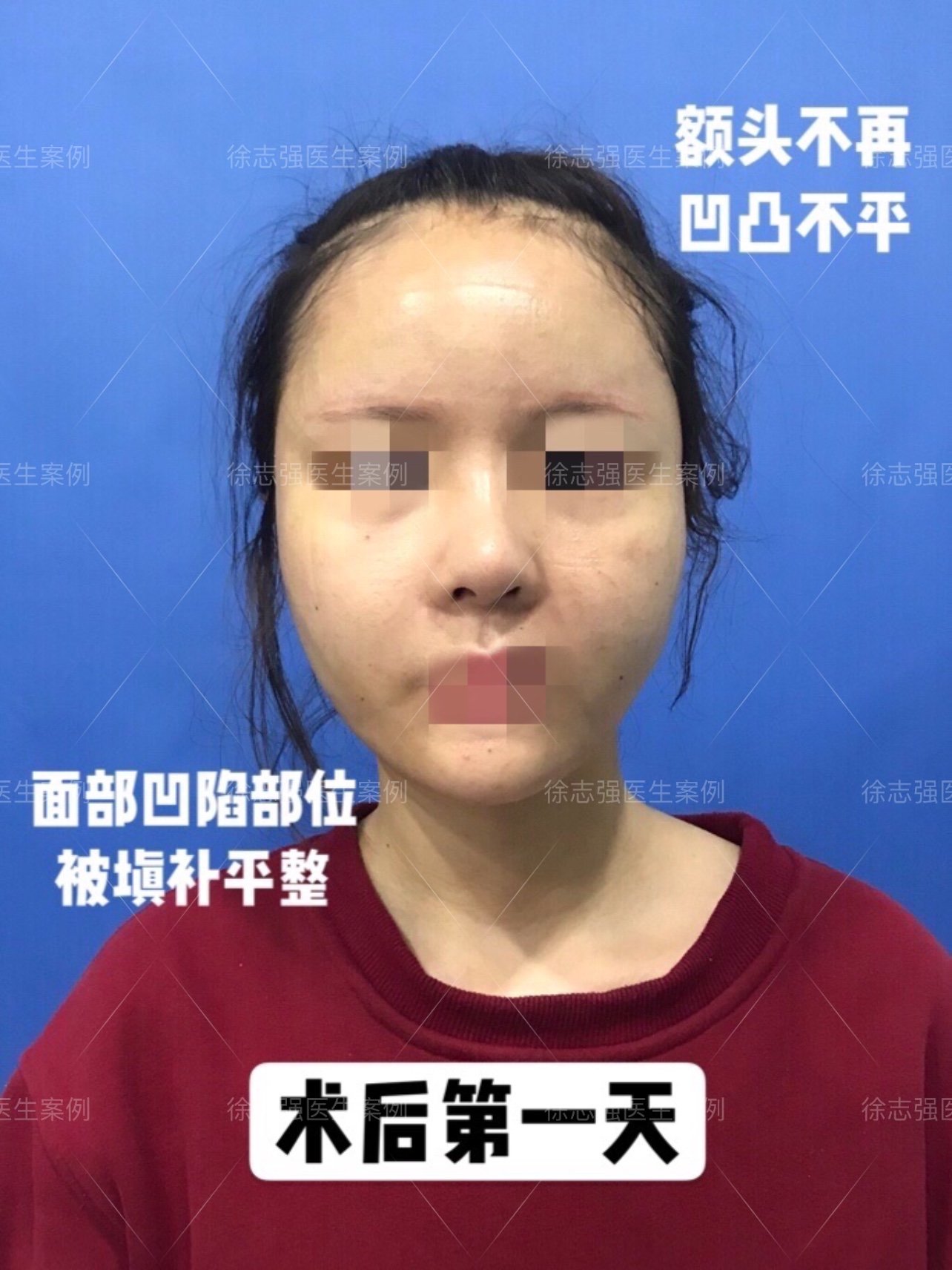 面部填充手术_面部填充手术风险大吗_面部填充术