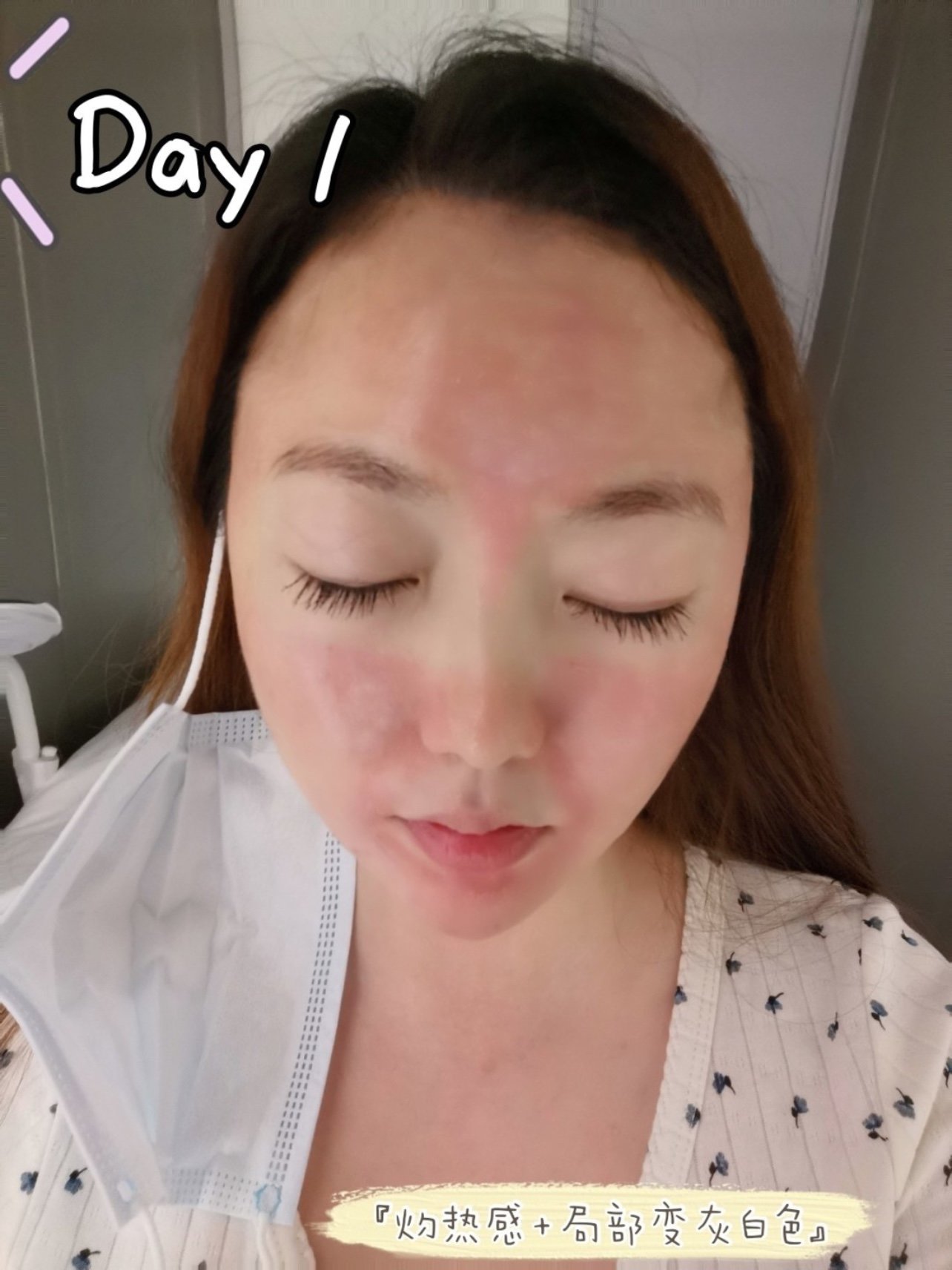 分享一下我滴刷酸七天情况给大家参考参考day1:做_圈子-新氧美容整形