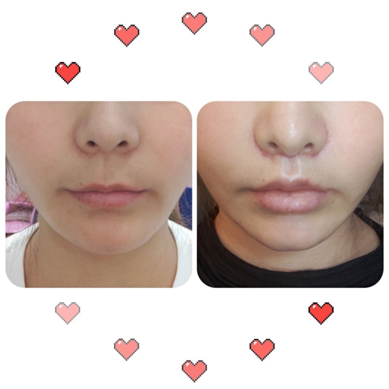 在吴学勤做的是人中缩短 人中加深