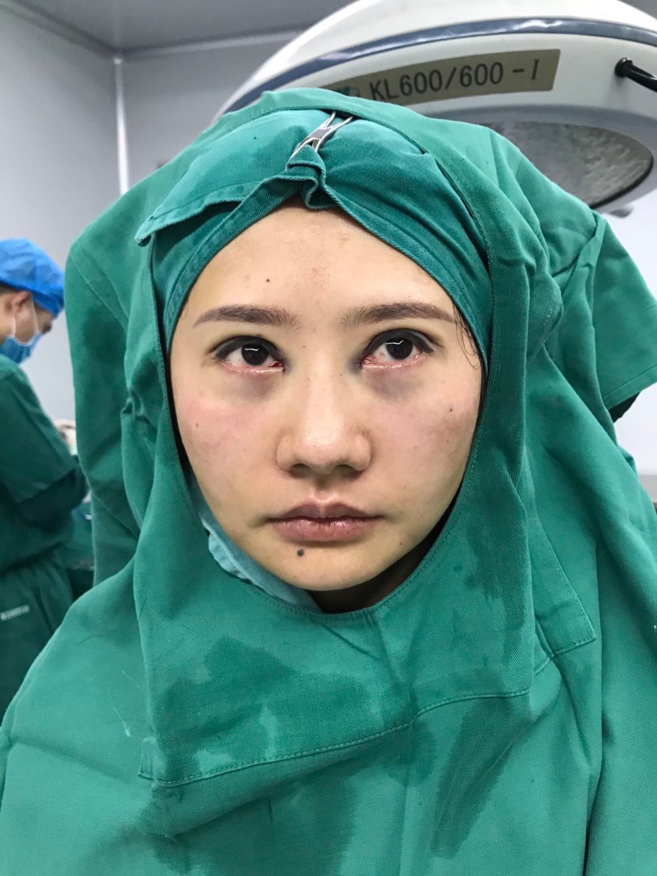 我最开始的时候眼睛小小的,看起来双目无神,让人看起_圈子-新氧美容