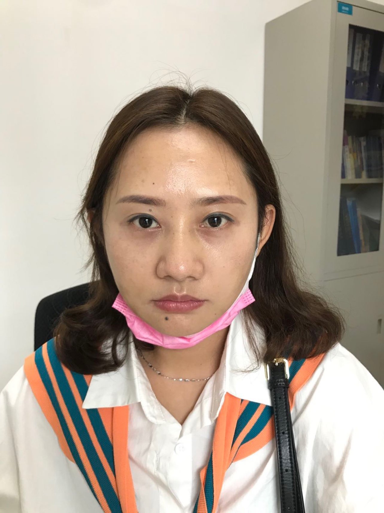 我最开始的时候眼睛小小的,看起来双目无神,让人看起_圈子-新氧美容