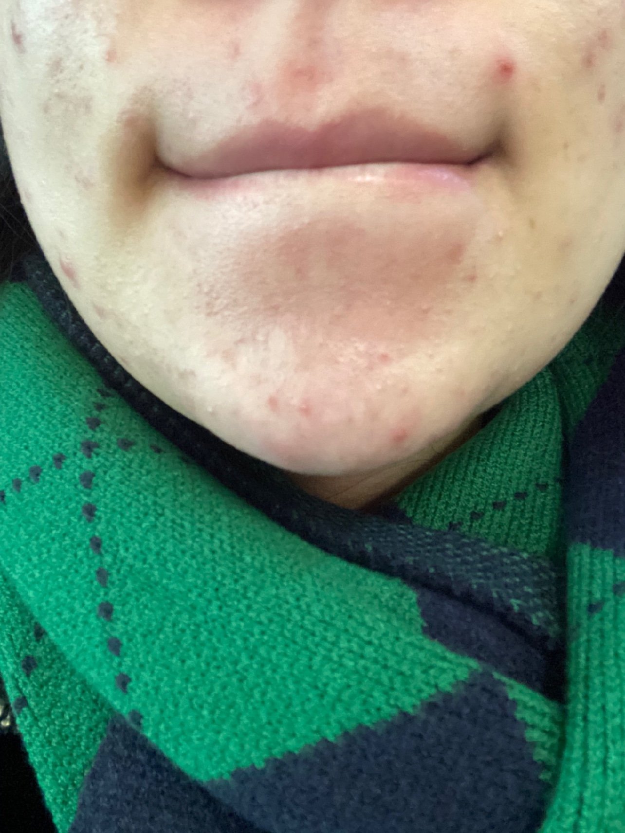 皮肤情况:油痘肌,雄性激素原因,爆痘三个月,期间有在服用优思悦,涂