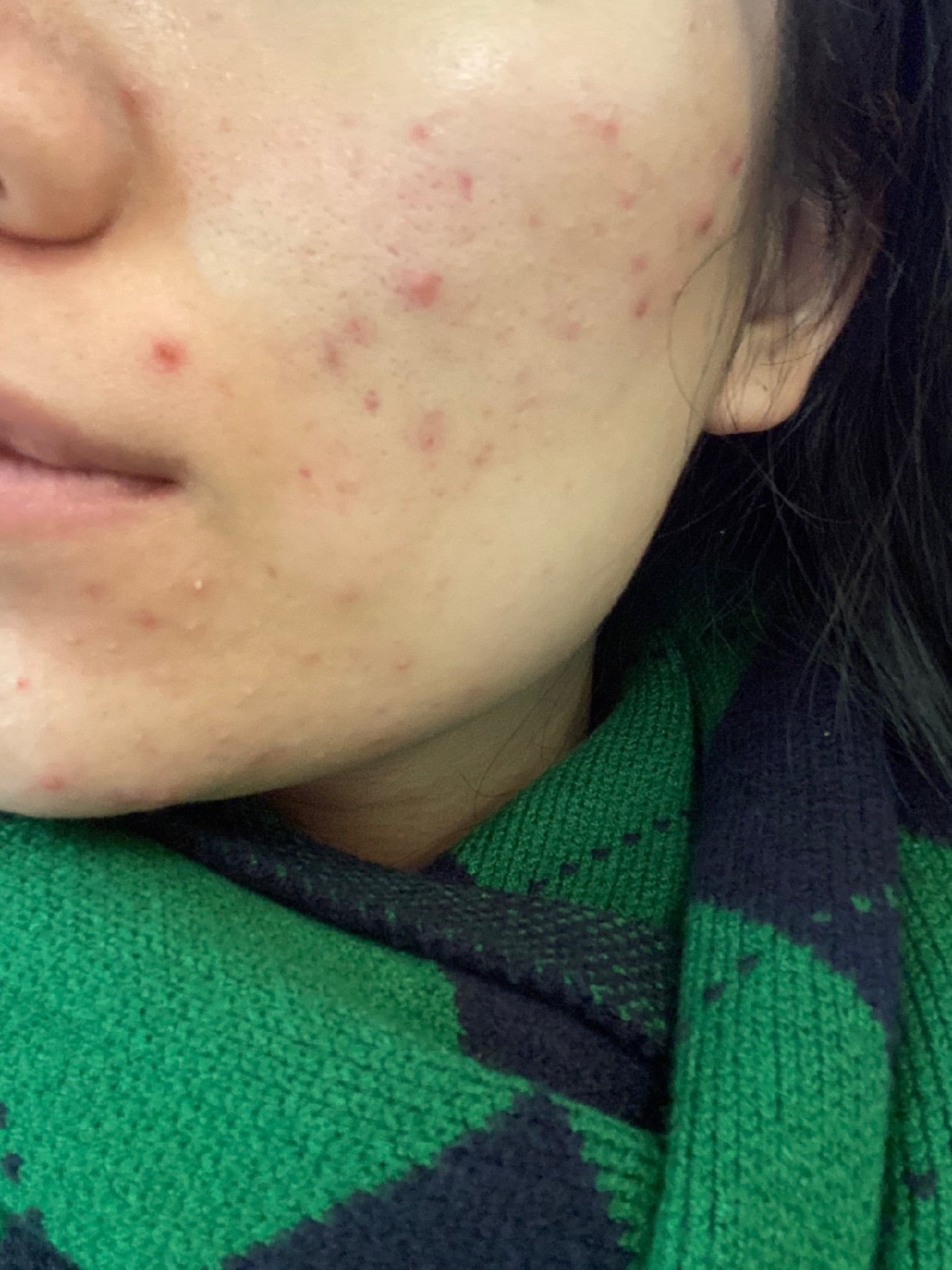 皮肤情况:油痘肌,雄性激素原因,爆痘三个月,期间有在服用优思悦,涂