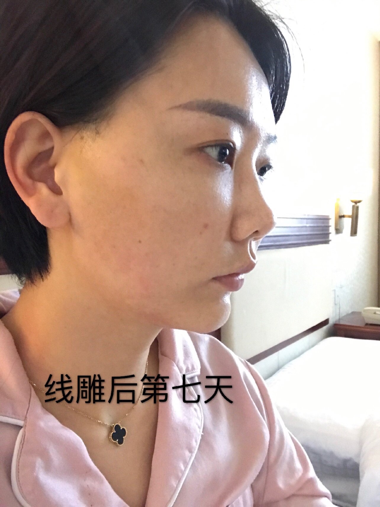 秘特线雕第七天恢复效果来啦!