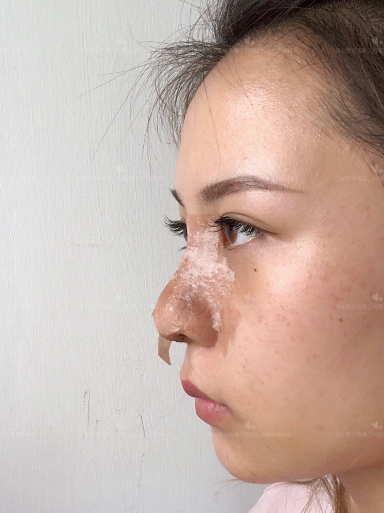 【术前诊断】:山根低,鼻翼肥大外扩,鼻基底低,鼻小_圈子-新氧美容整形