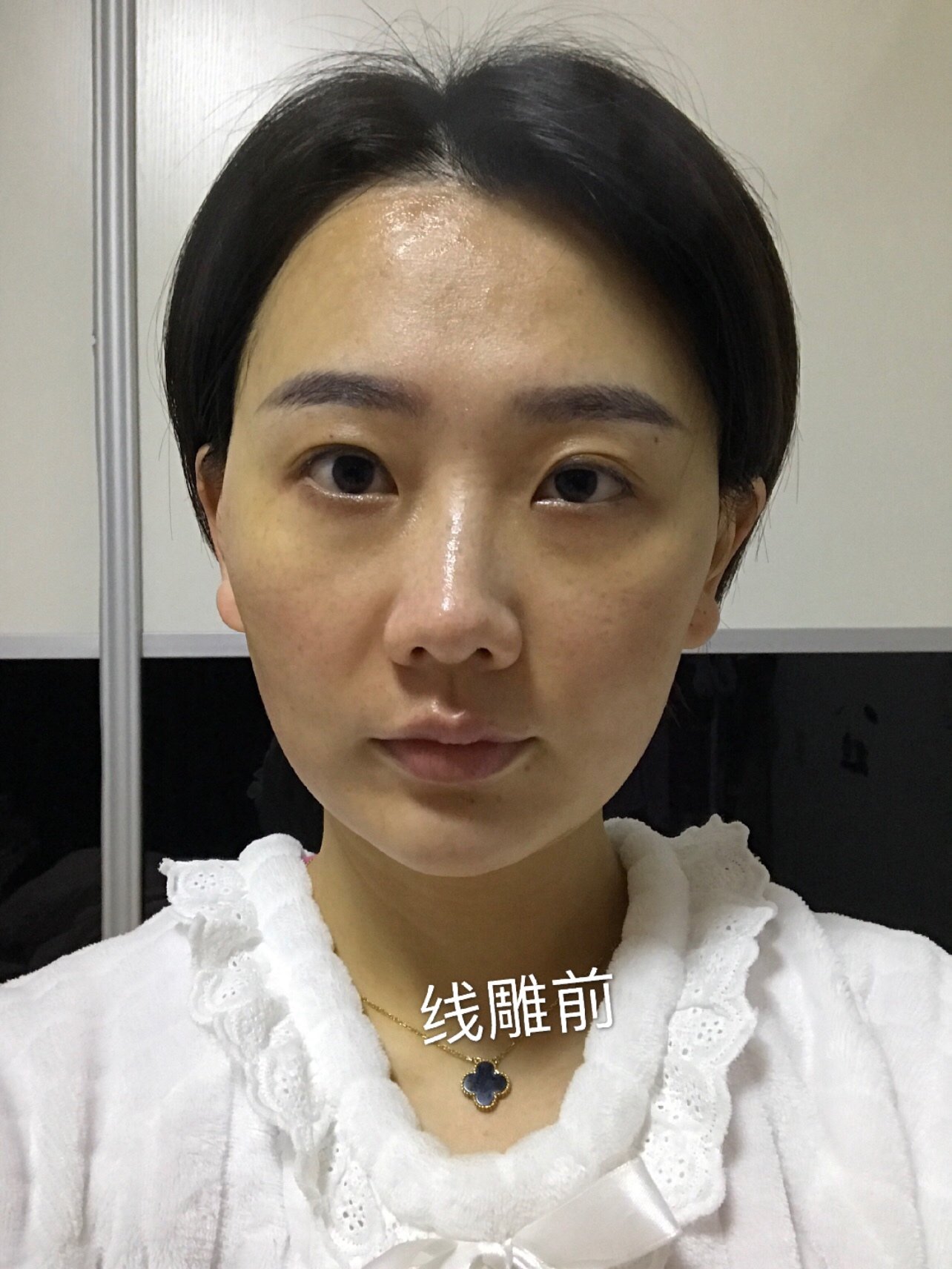 秘特线雕第七天恢复效果来啦!