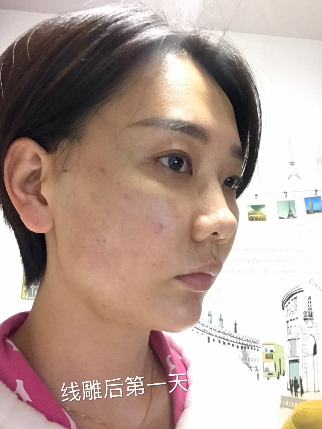 秘特线雕第七天恢复效果来啦!