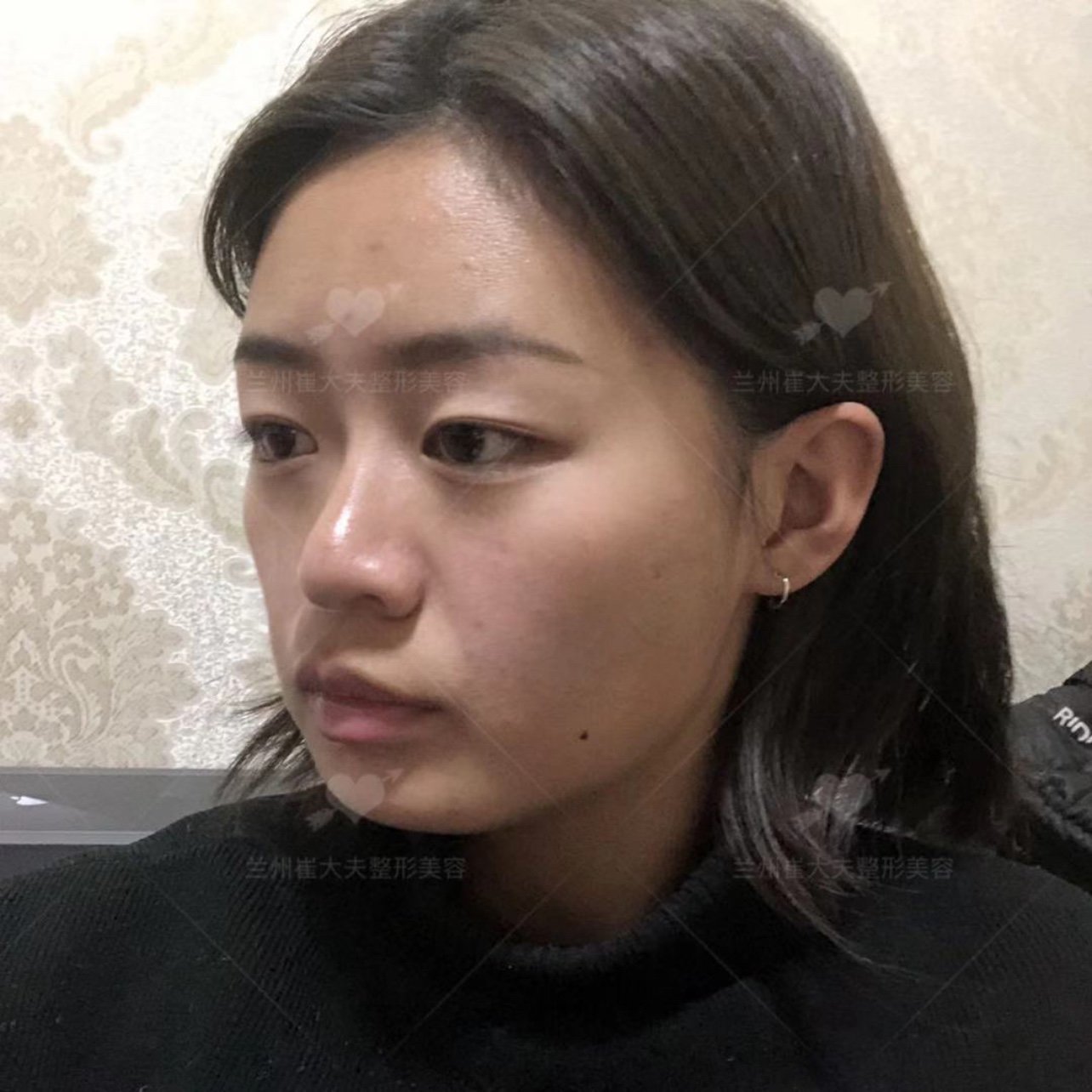 【术前诊断】:求美者整体面部轮廓凹凸不平,缺乏元气_圈子-新氧美容