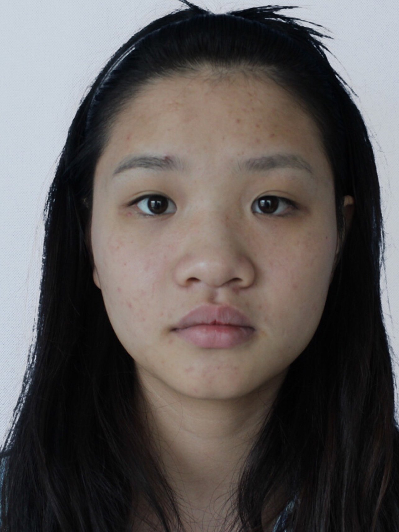 没做眼睛鼻子之前我的五官非常扁平,没有特色,也可以_圈子-新氧美容