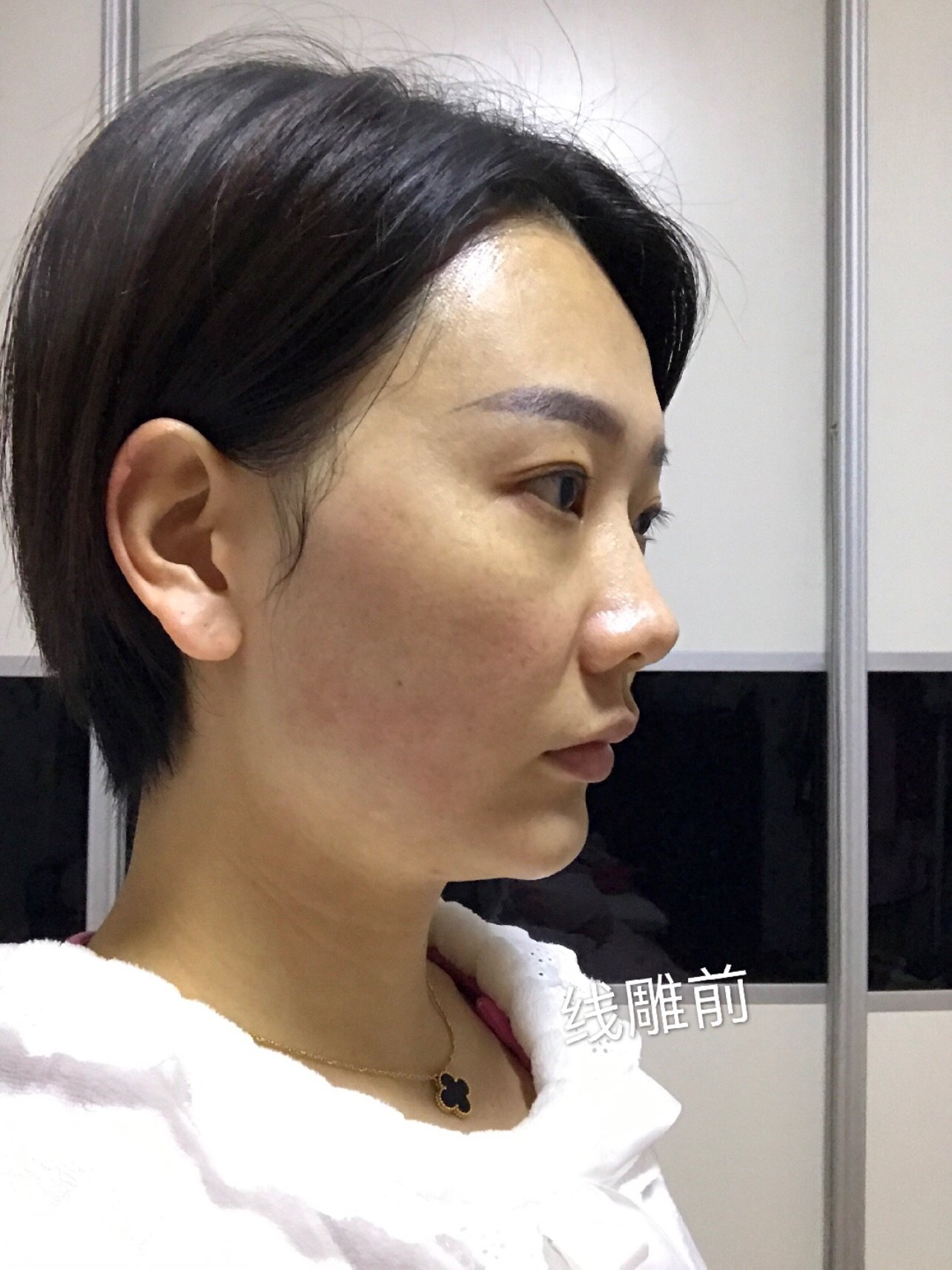 秘特线雕第七天恢复效果来啦!