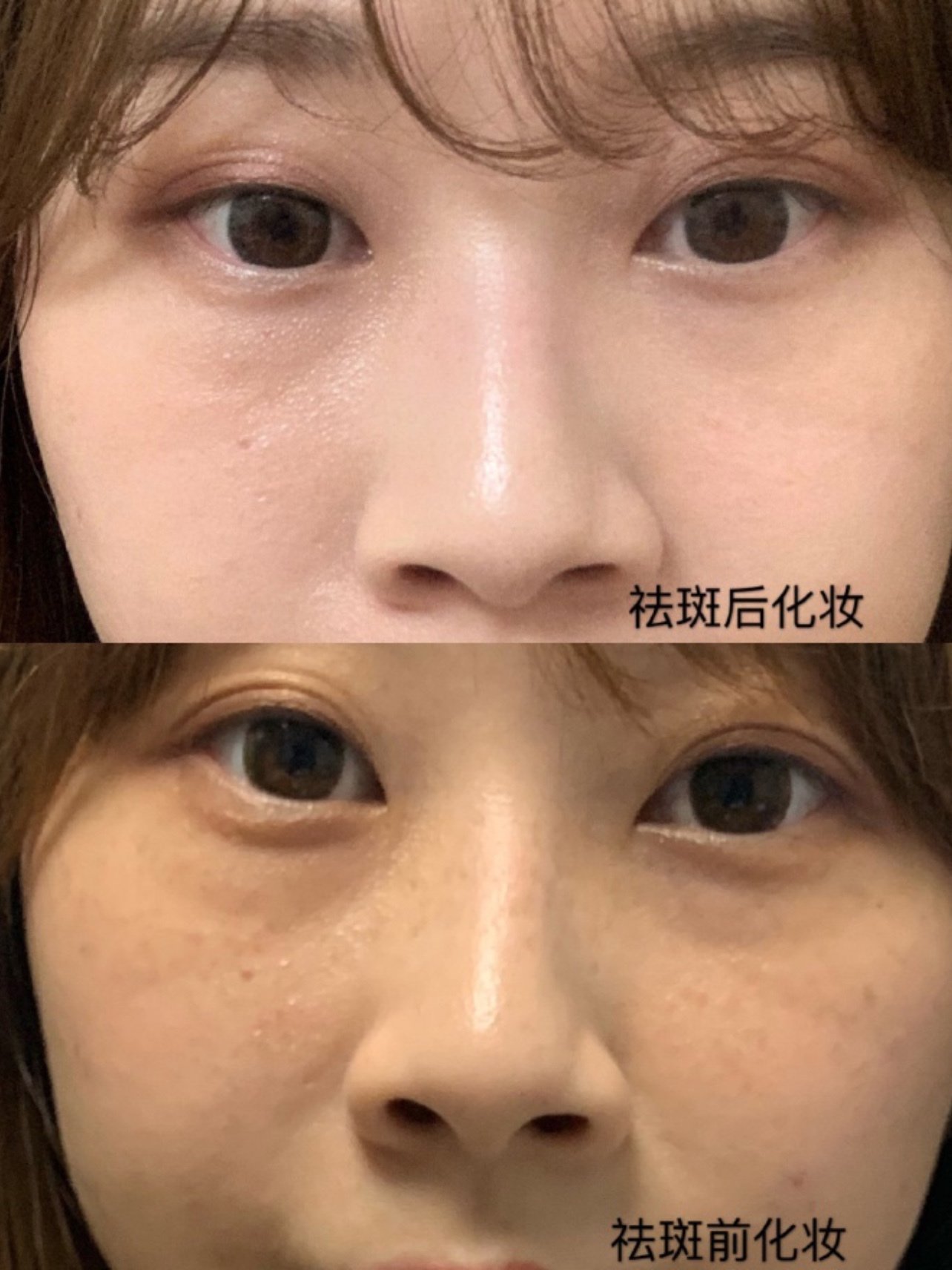 调q祛斑通过激光的选择性光热作用,靶向"击碎"皮肤_圈子-新氧美容整形