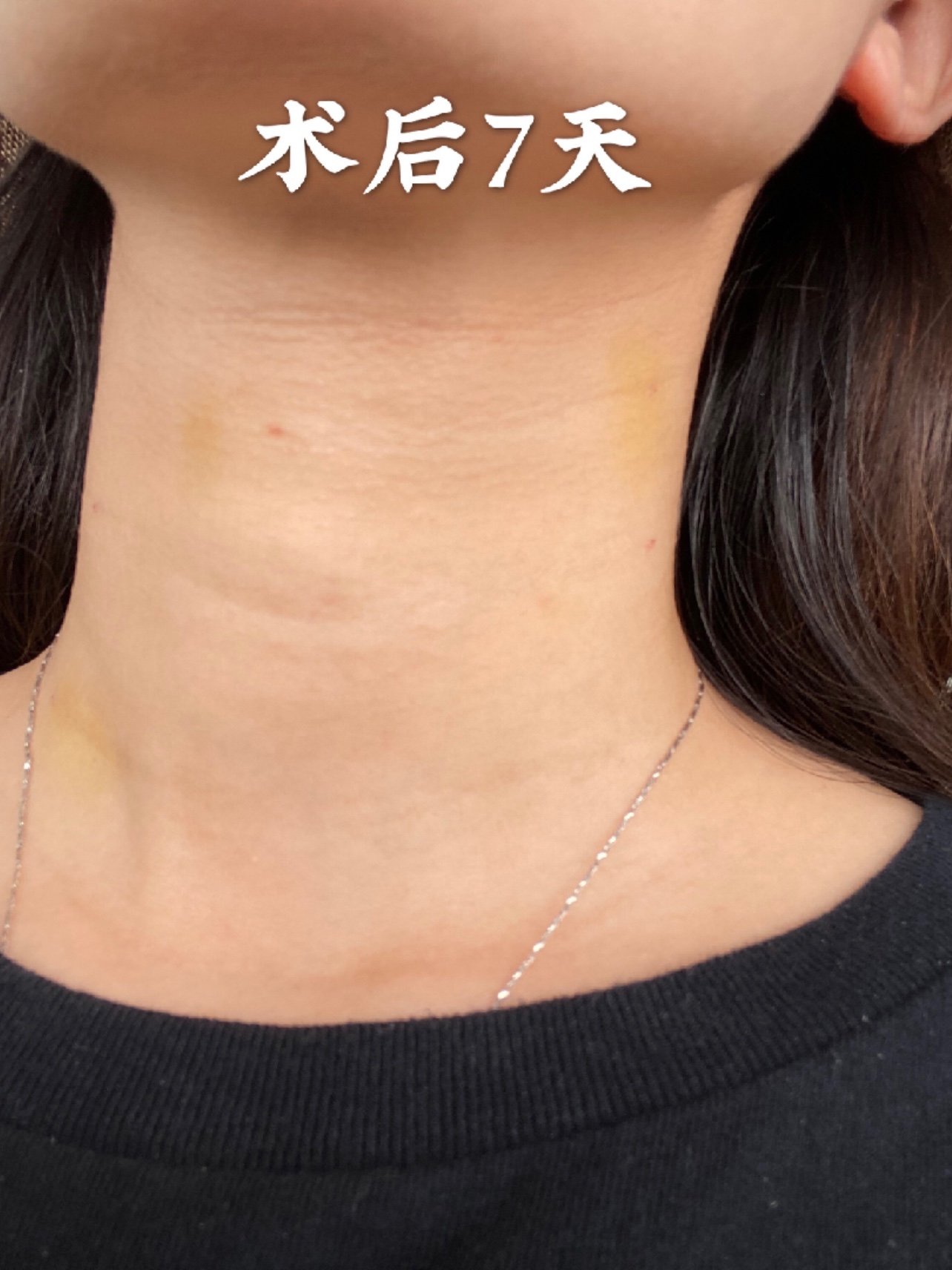 99术前姑娘脖颈子上已经有了三道严重的颈纹,脸还是保