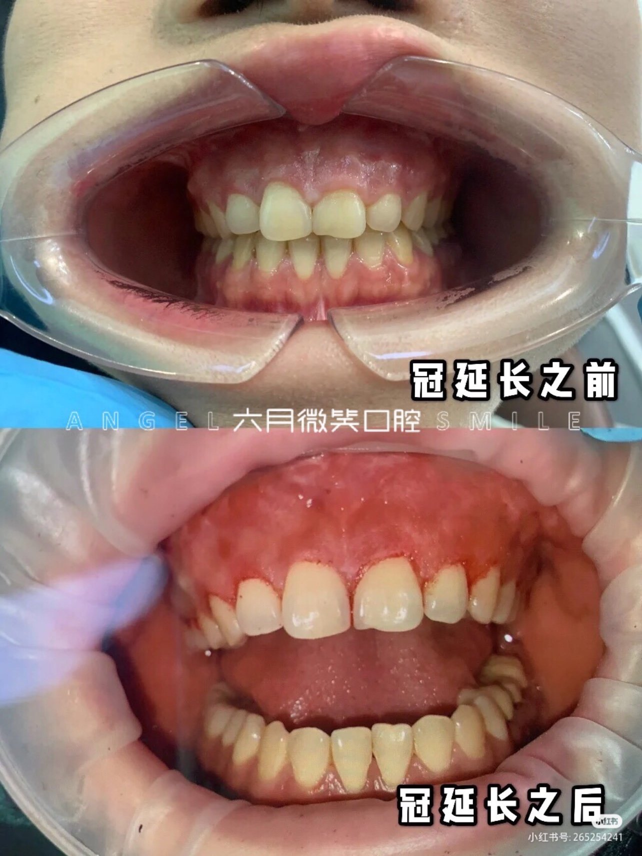 牙龈过长,会导致我们在微笑的时候,露出自己的牙_圈子-新氧美容整形