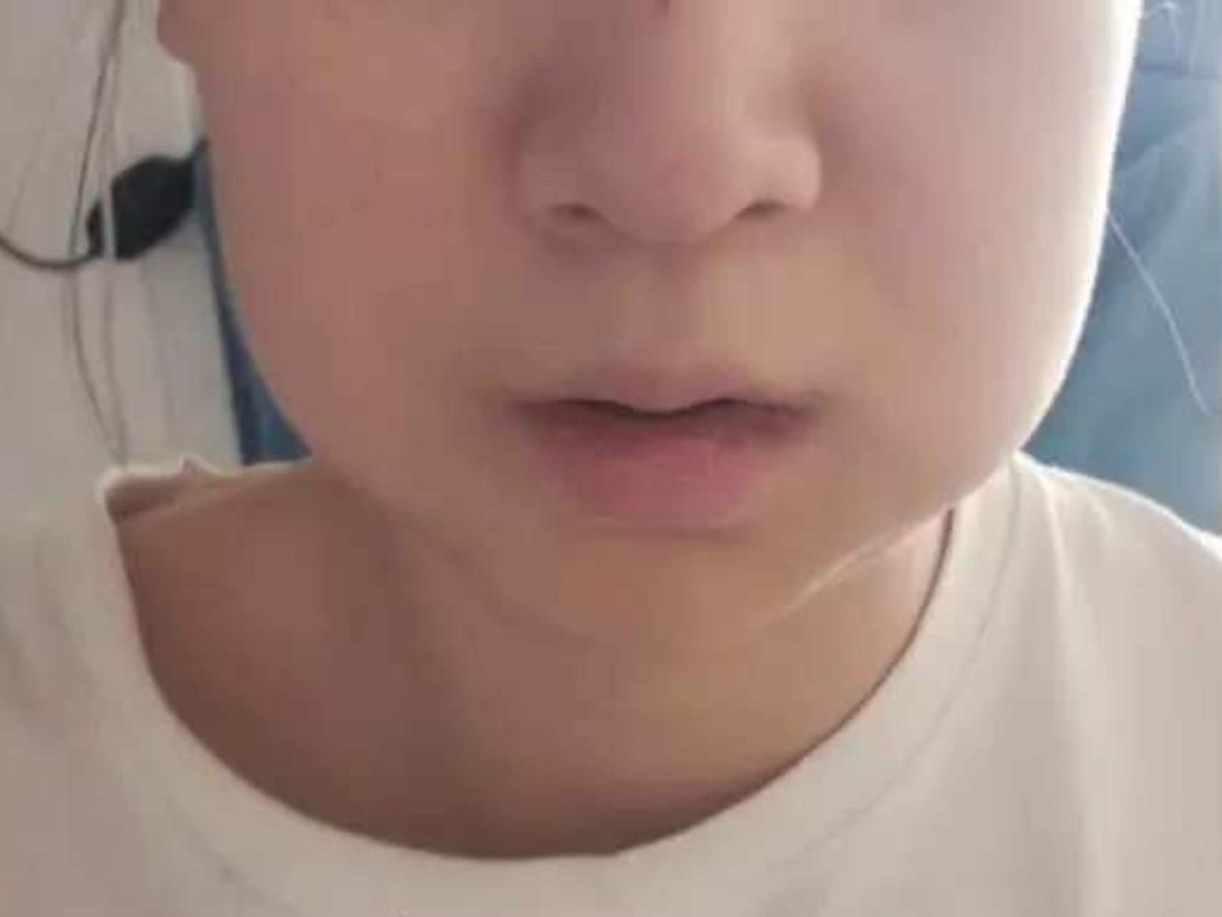 拔智齿后脸为什么会肿?今天过来拔智齿的正畸患者正好问了这个问题.